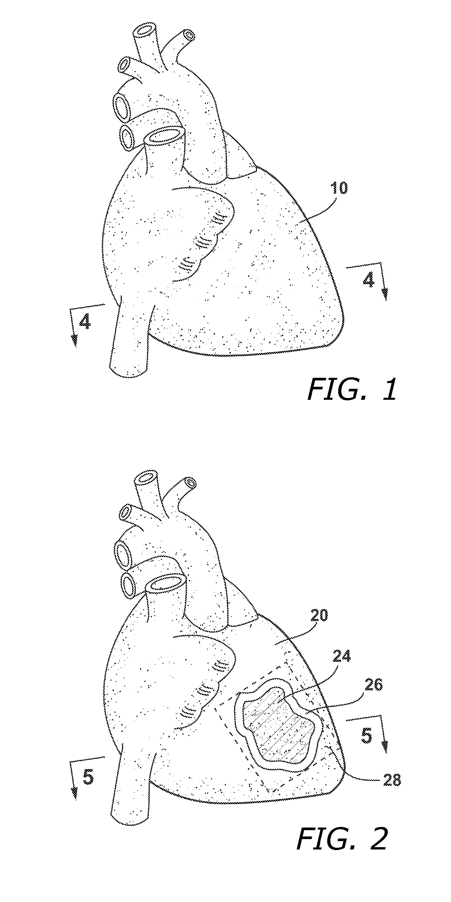 Methods and Systems for Treating Injured Cardiac Tissue