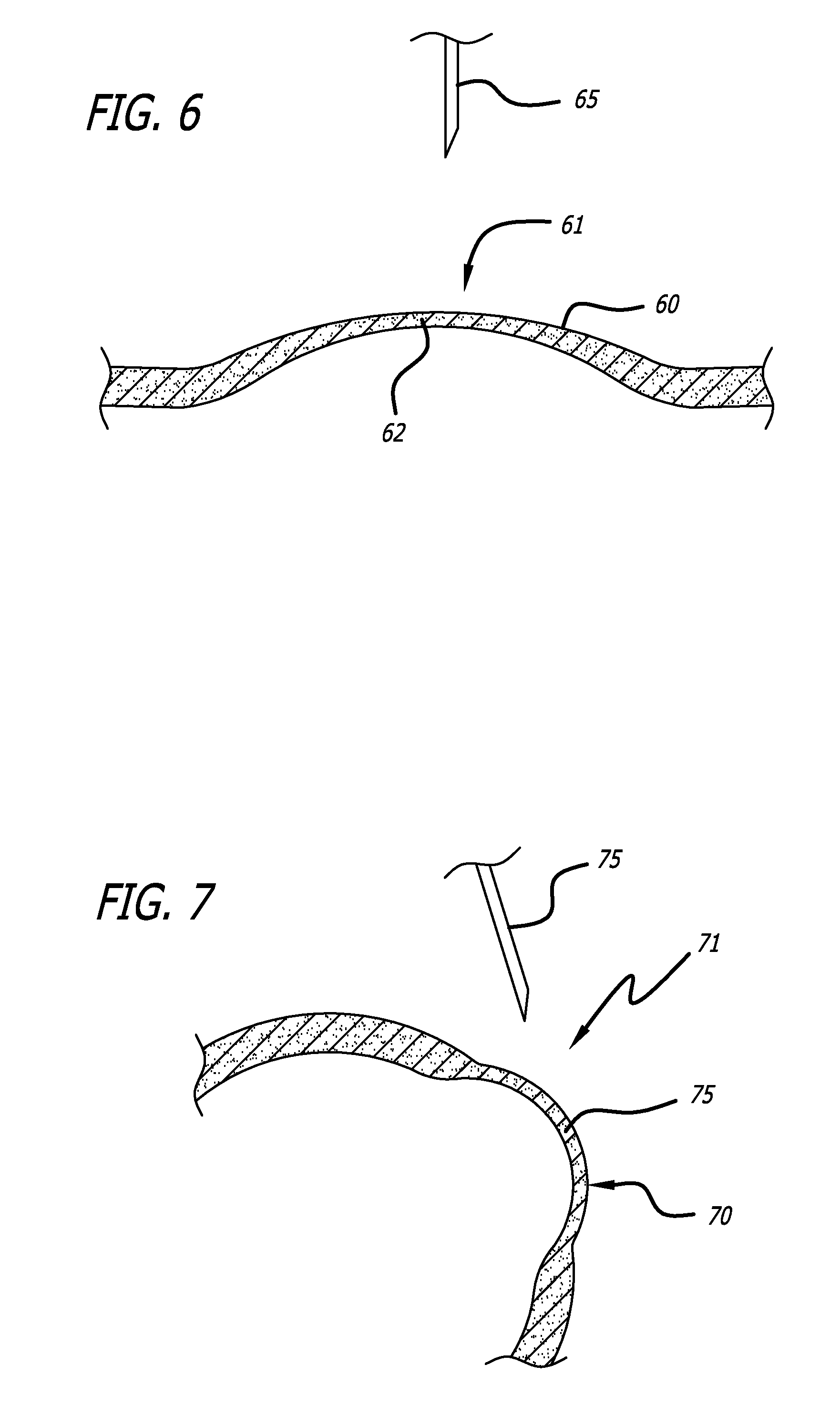 Methods and Systems for Treating Injured Cardiac Tissue