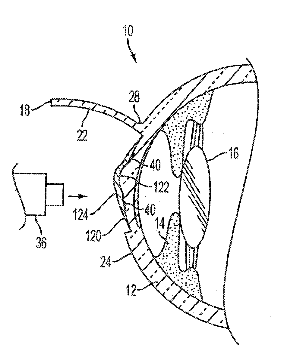 Method of altering the refractive properties of an eye