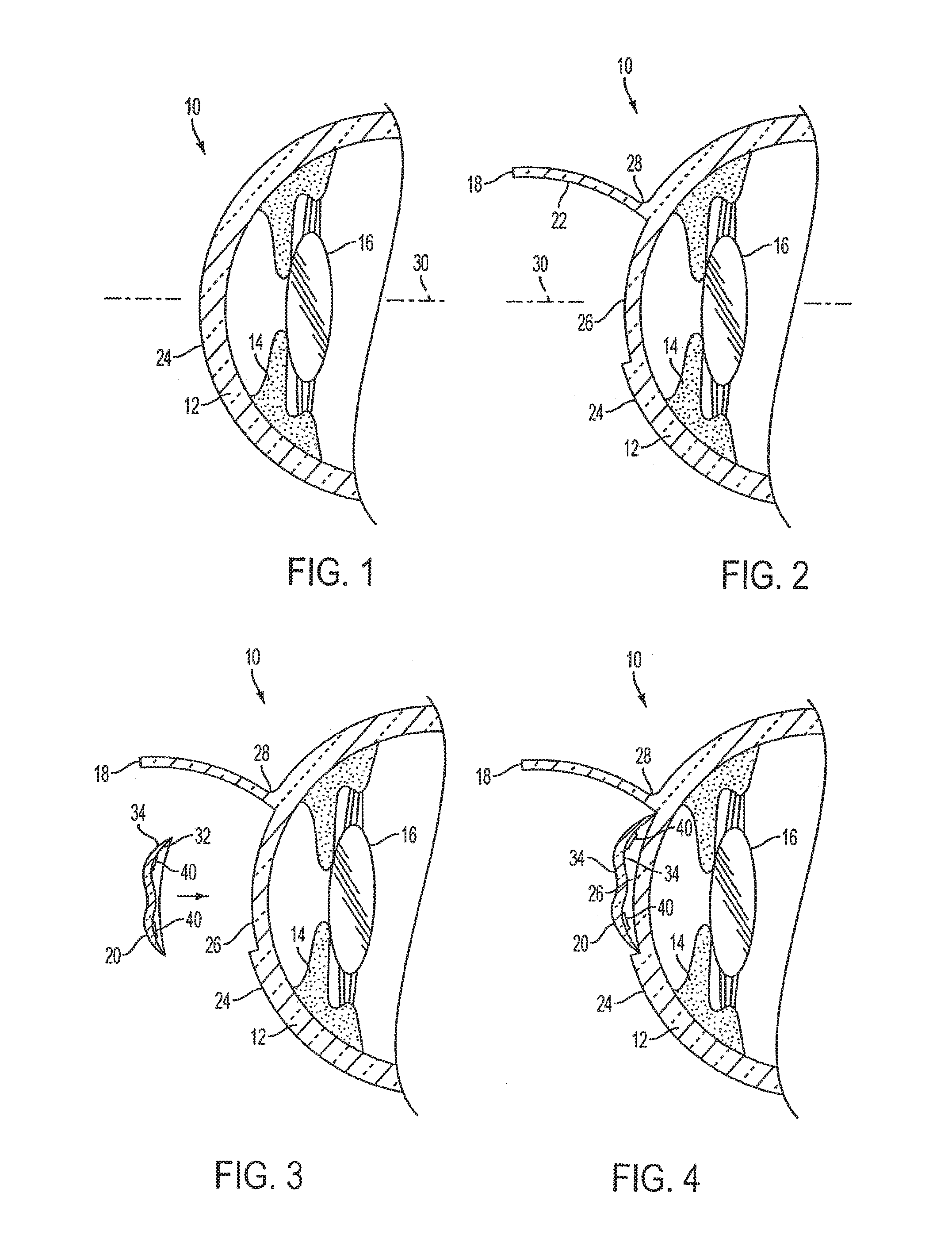 Method of altering the refractive properties of an eye