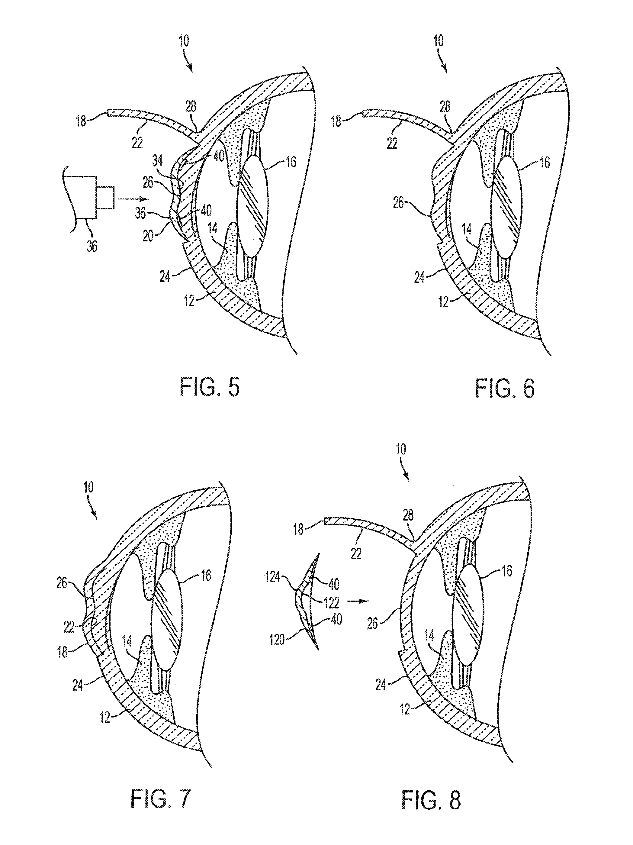 Method of altering the refractive properties of an eye