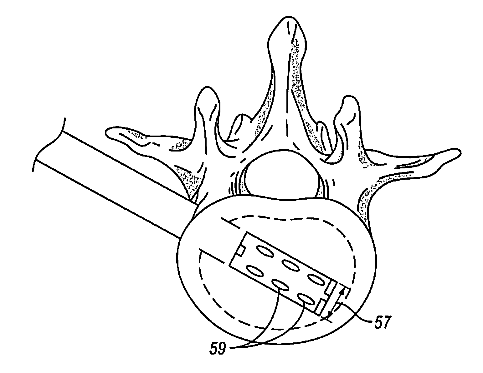 Devices and Methods for Treating Bone