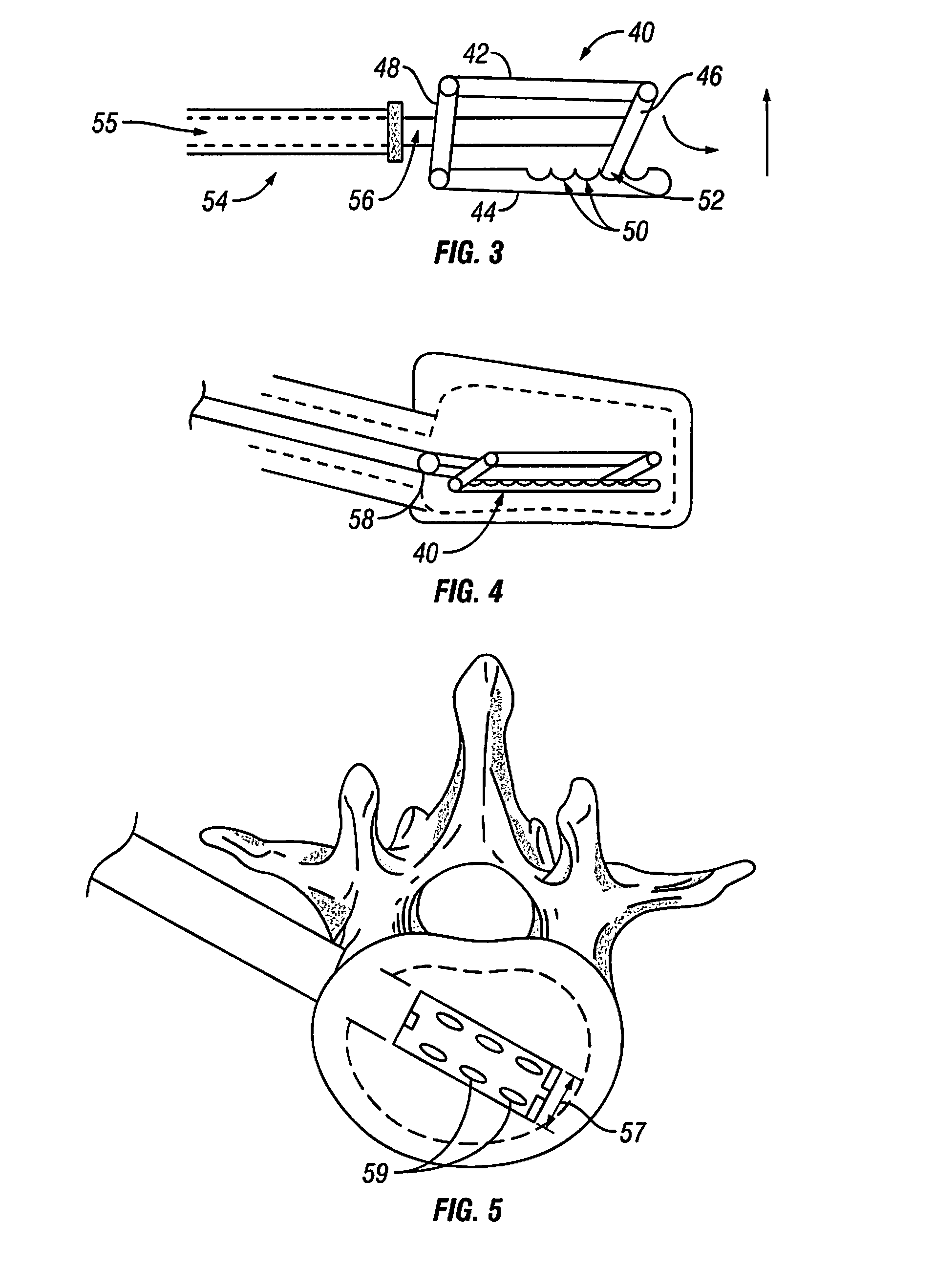 Devices and Methods for Treating Bone