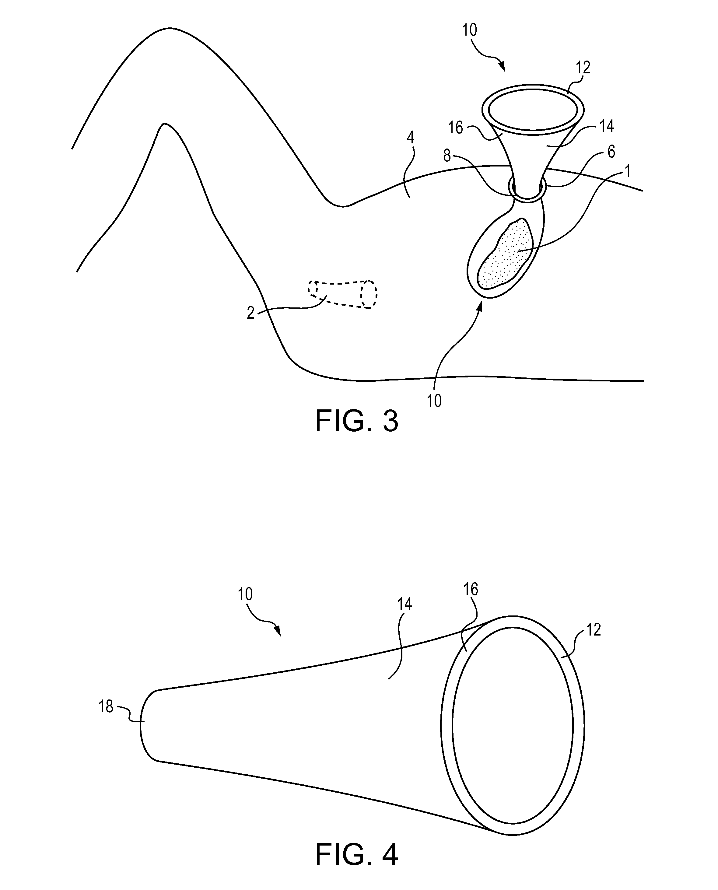 Methods for Isolating and Removing Tissue During a Female Patient's Laparoscopic Surgery