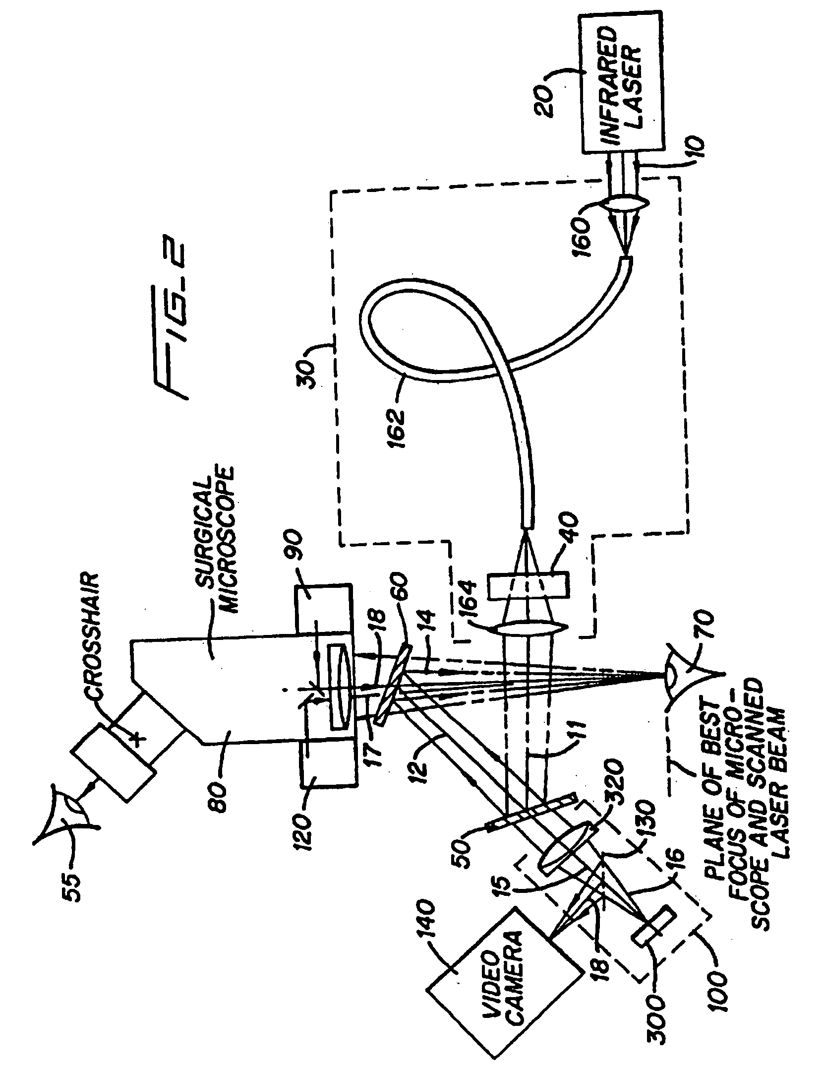 Method and apparatus for removing corneal tissue with infrared laser radiation and short pulse mid-infrared parametric generator for surgery