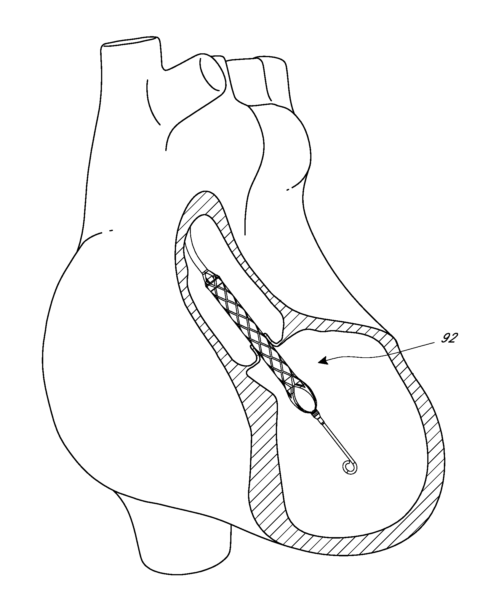 Sheath system for catheter pump