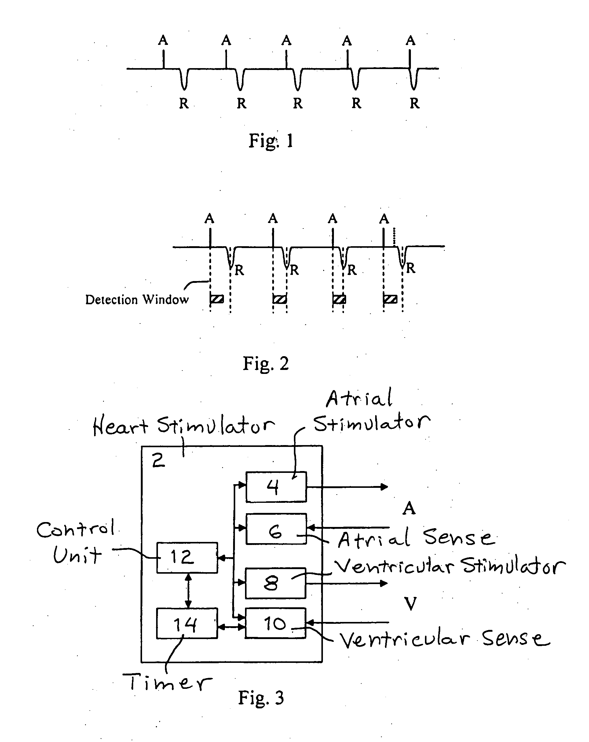 Implantable Heart Stimulator for Enabling Normal Atrio-Ventricular Stimulation Sequence in the Presence of Av-Nodal Interference