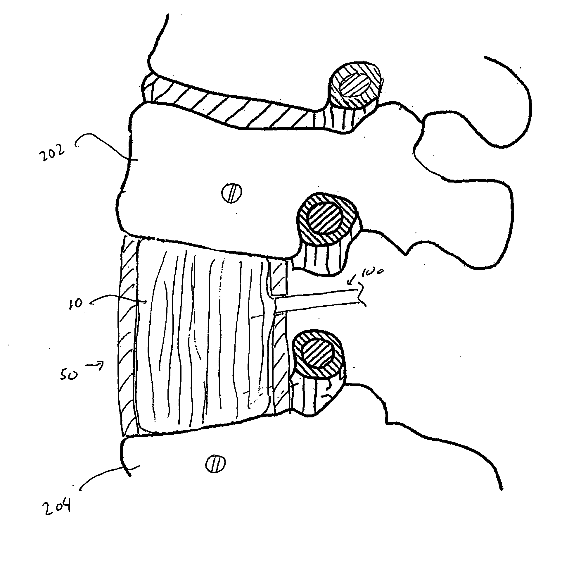 Formed in place corpectomy device