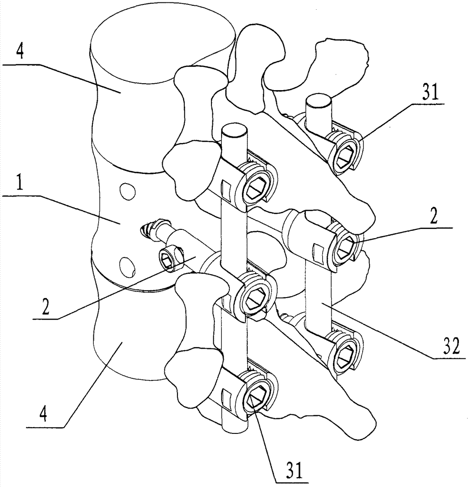 Vertebral body union internal fixation system