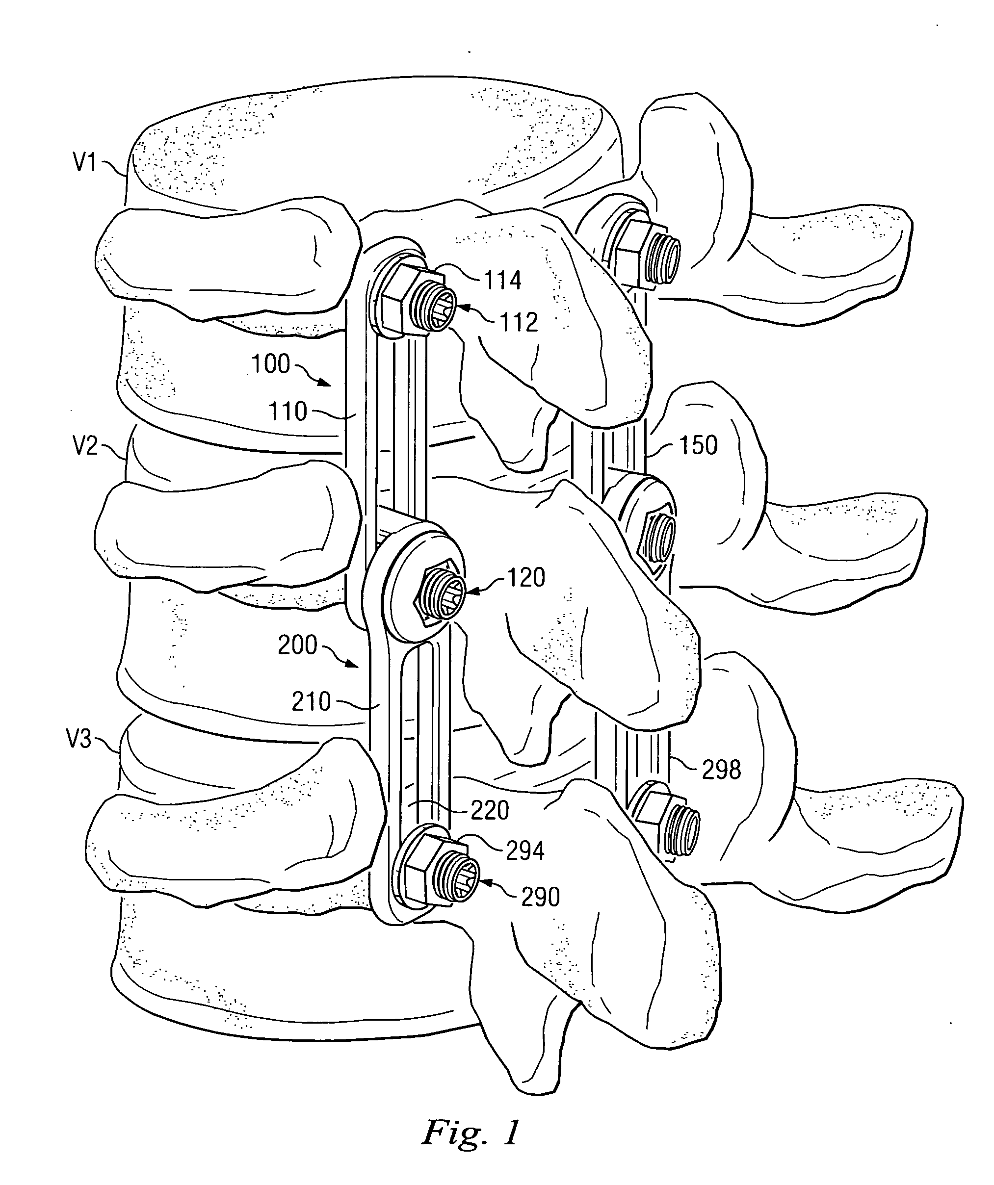 Revision fixation plate and method of use