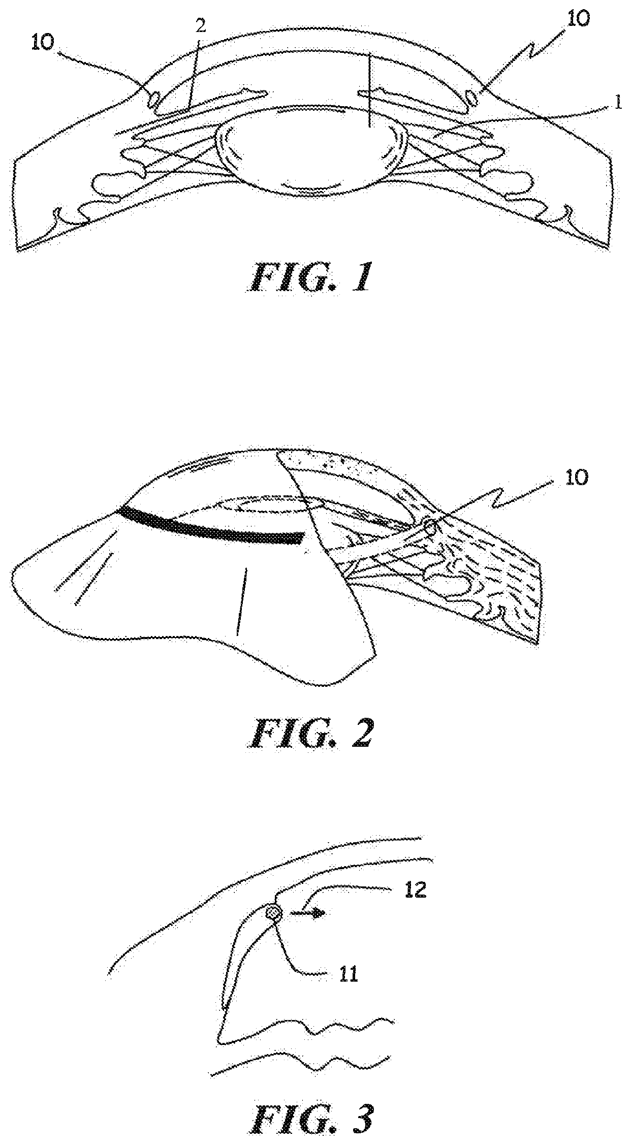 Ophthalmic implant for treatment of glaucoma