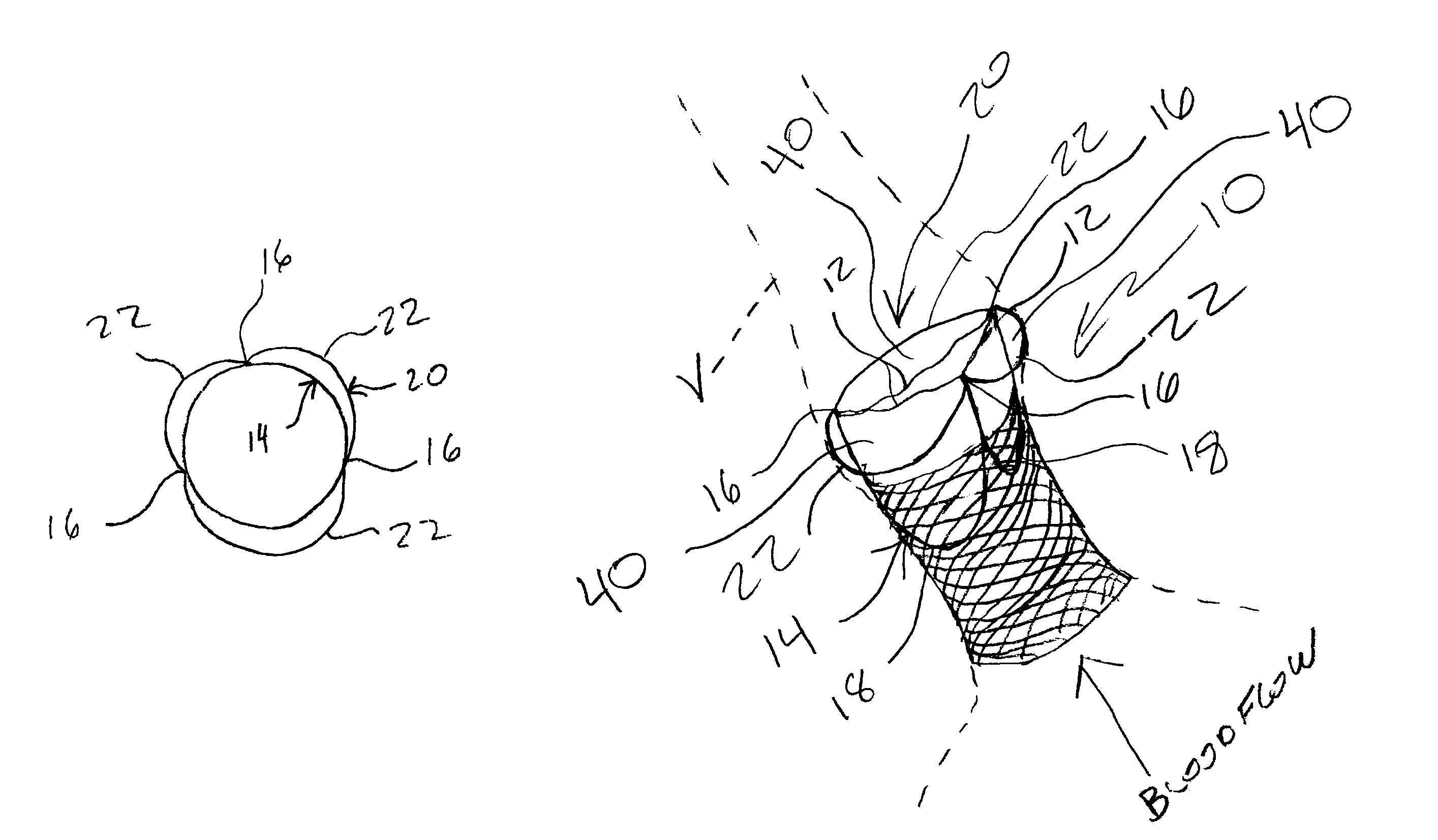 Reinforced commissural support structure