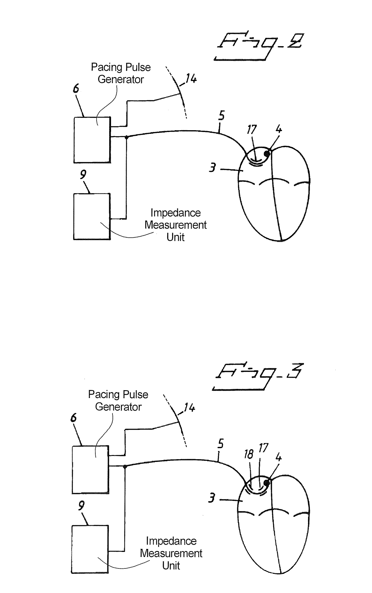 Heart stimulator detecting atrial arrhythmia by determining wall distension by impedance measuring