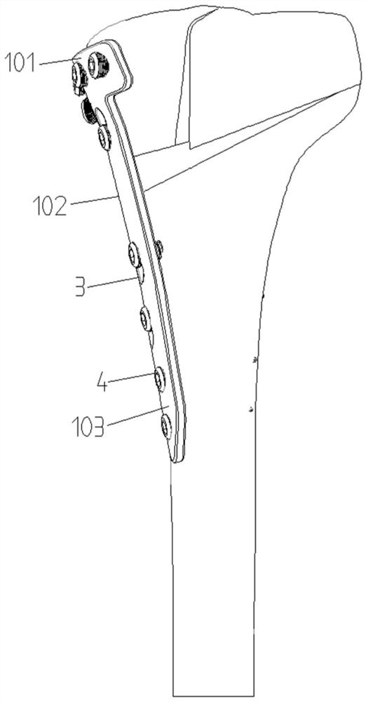 Special internal fixing device for proximal tibia joint osteotomy