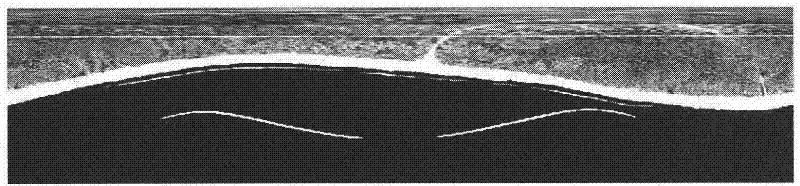 A Post-processing Method for Removing Ring Artifacts in CT Images