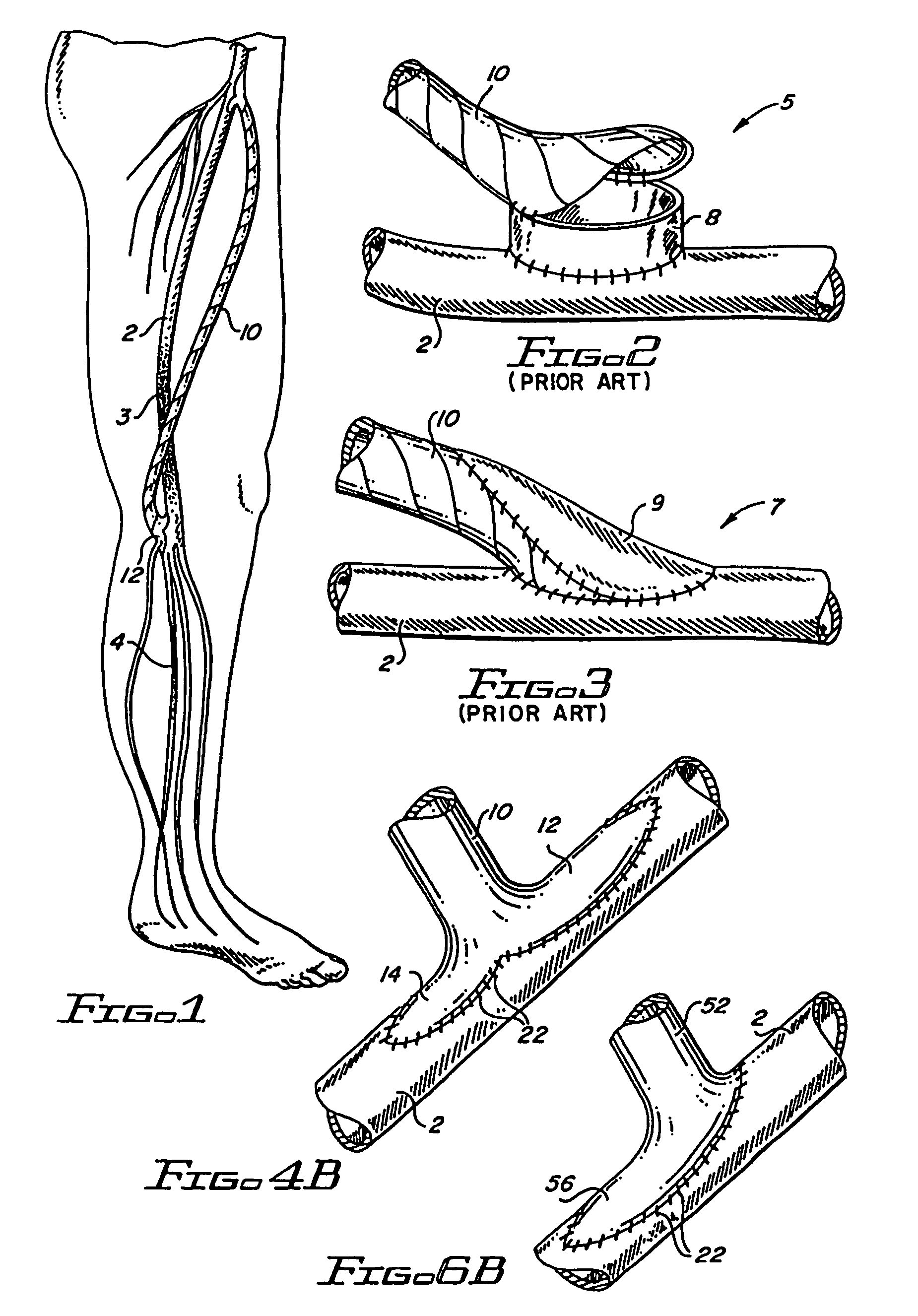 Flanged graft for end-to-side anastomosis