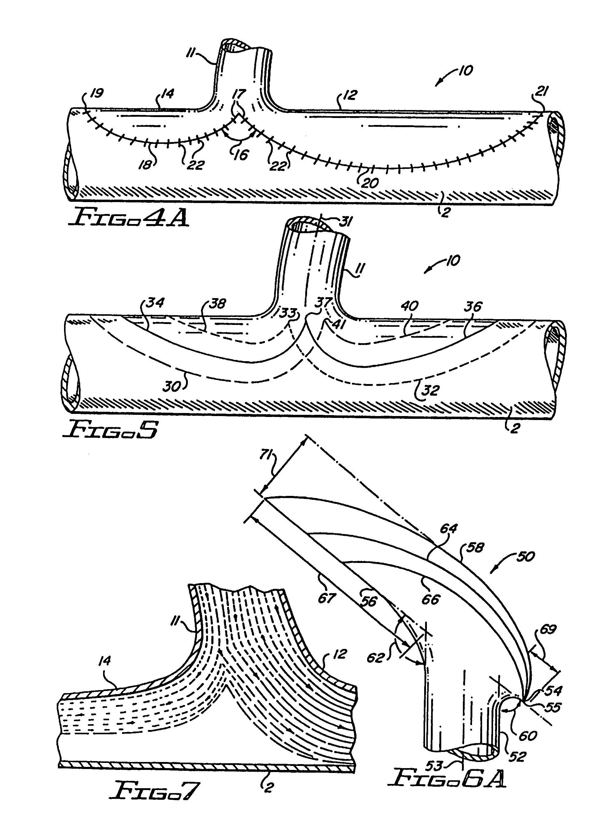 Flanged graft for end-to-side anastomosis