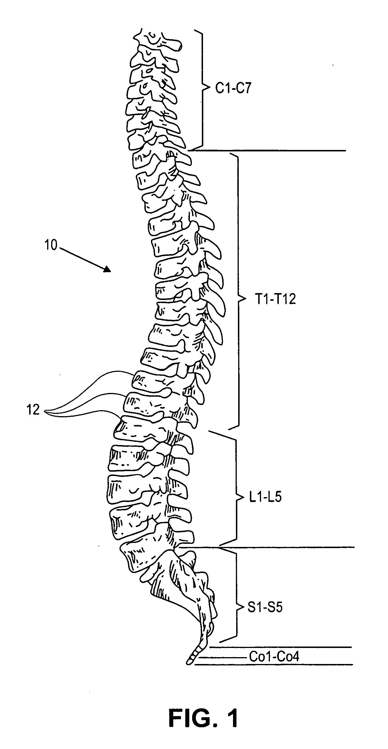 Prostheses, tools and methods for replacement of natural facet joints with artificial facet joint surfaces