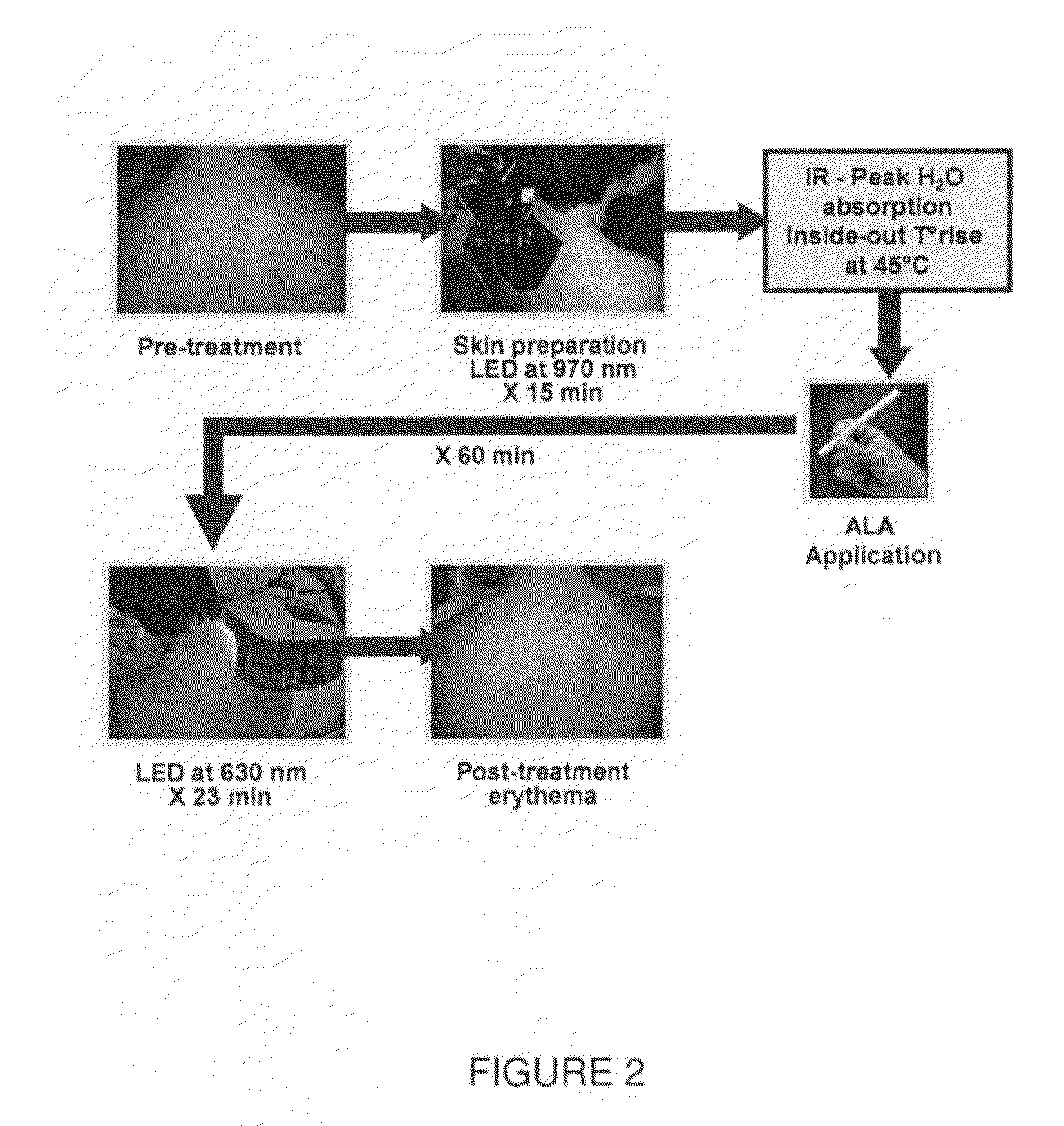 Radiant near infrared light emitting diode exposure as skin preparation