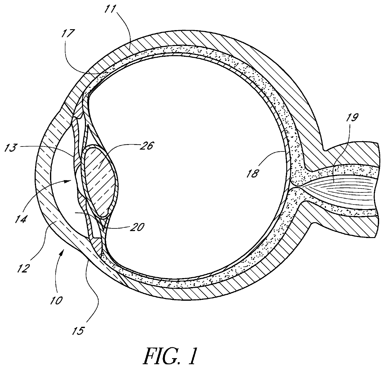 Glaucoma stent and methods thereof for glaucoma treatment