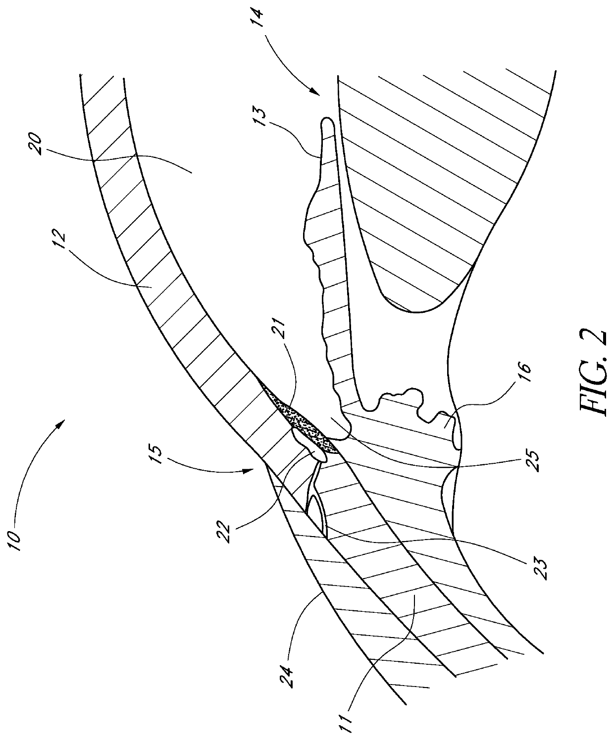 Glaucoma stent and methods thereof for glaucoma treatment