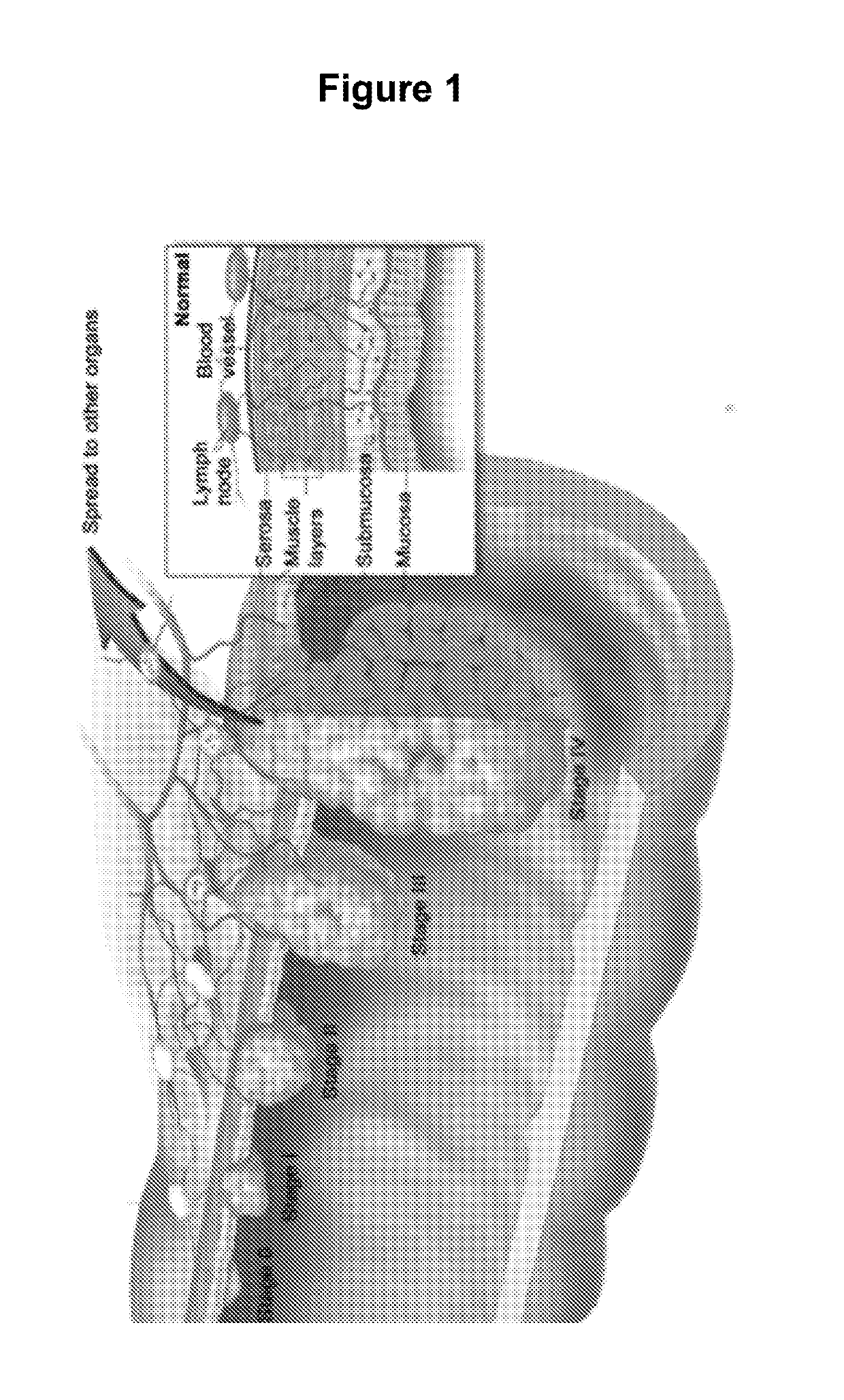 Methods for Detection, Staging, and Surveillance of Colorectal Adenomas and Carcinomas