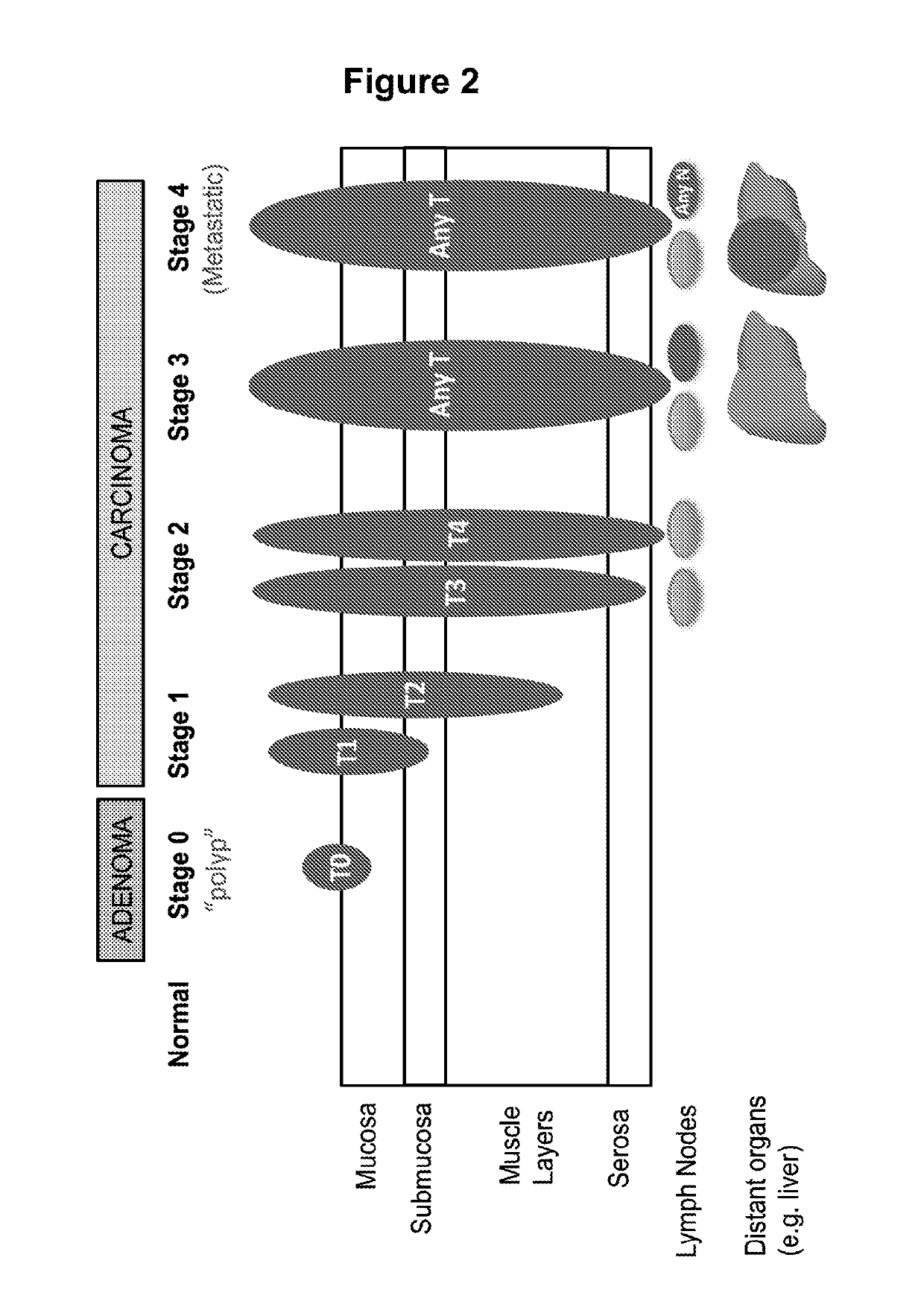 Methods for Detection, Staging, and Surveillance of Colorectal Adenomas and Carcinomas