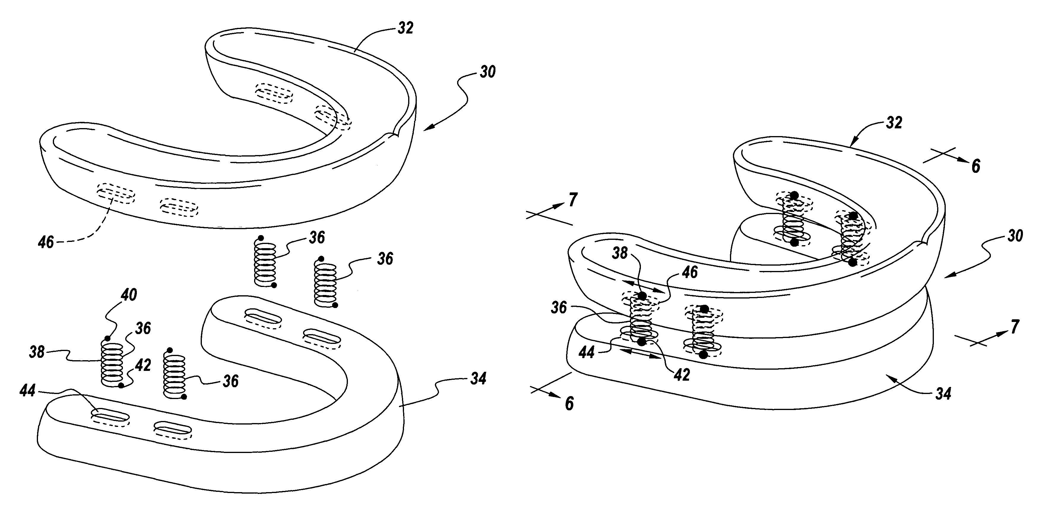 Method and apparatus for protecting teeth, preventing the effects of bruxism and protecting oral structures from sports injuries