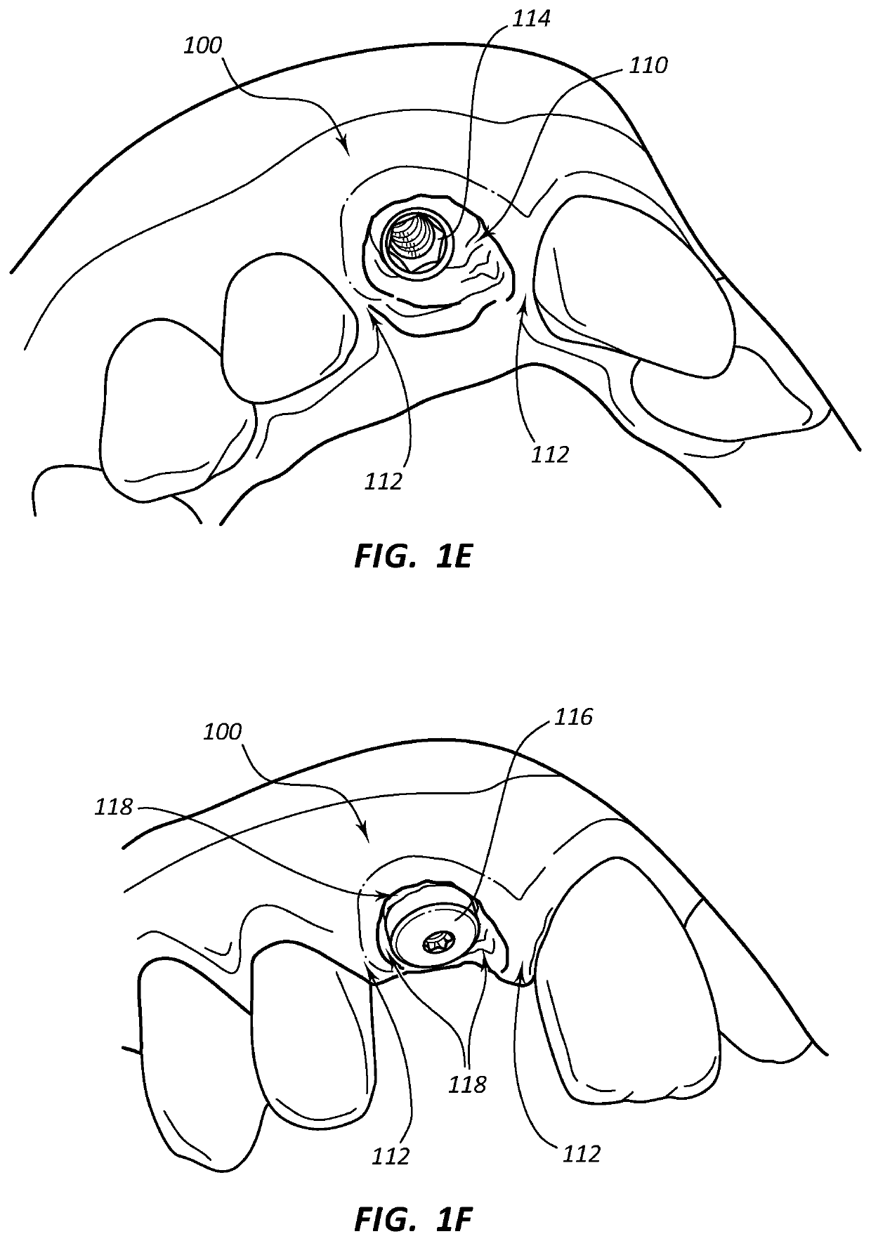 Dental implants with markers for determining three-dimensional positioning