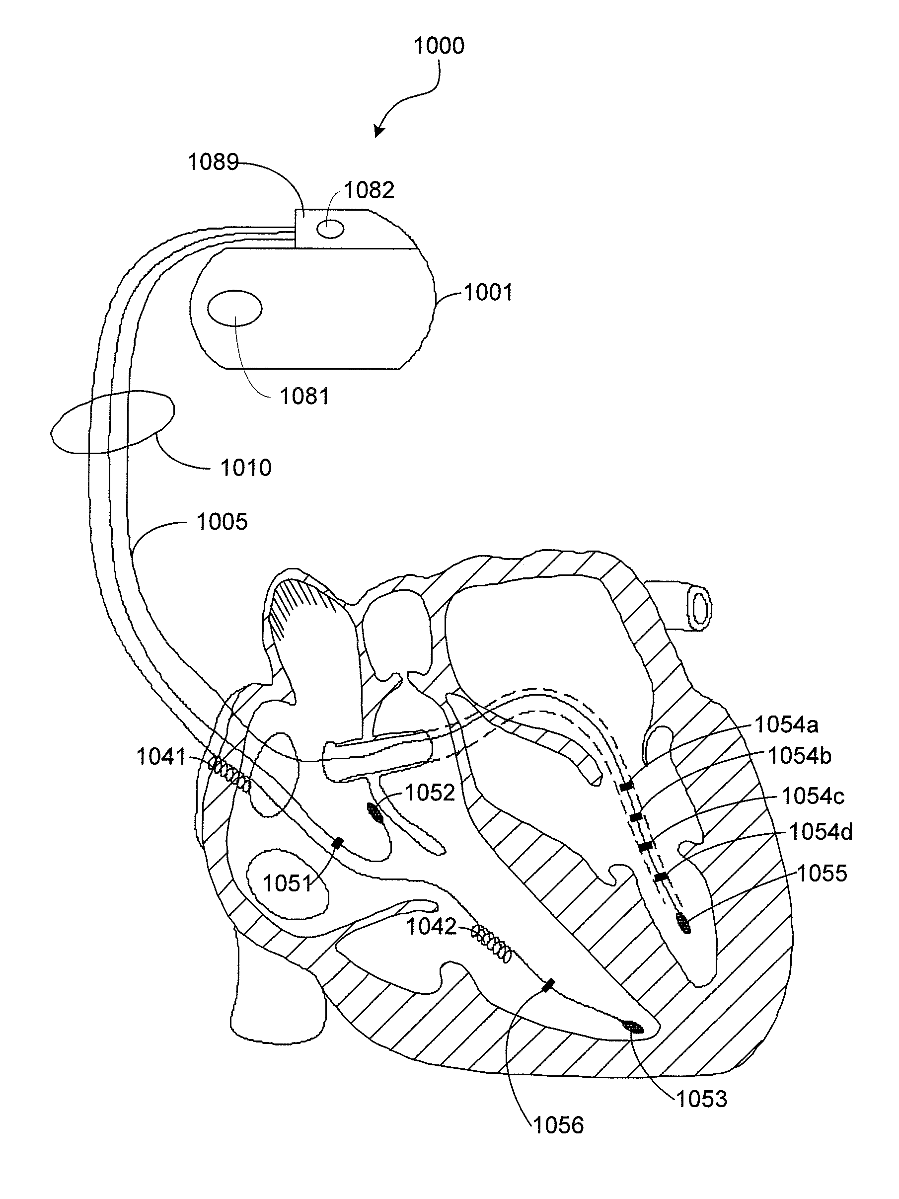 Method and Apparatus for Phrenic Nerve Activation Detection with Respiration Cross-Checking