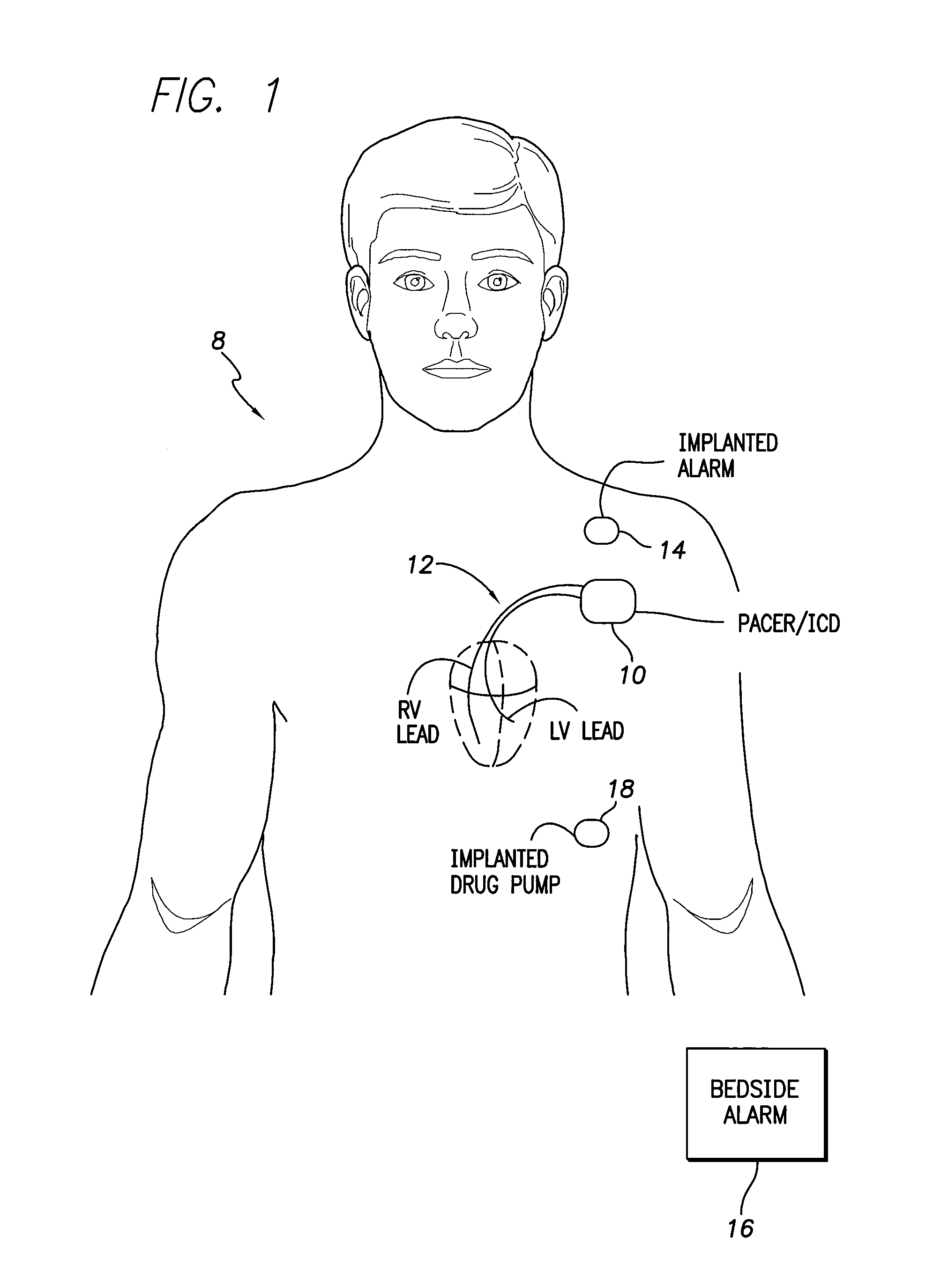 Systems and methods for detecting and compensating for changes in posture during ischemia detection a using an implantable medical device