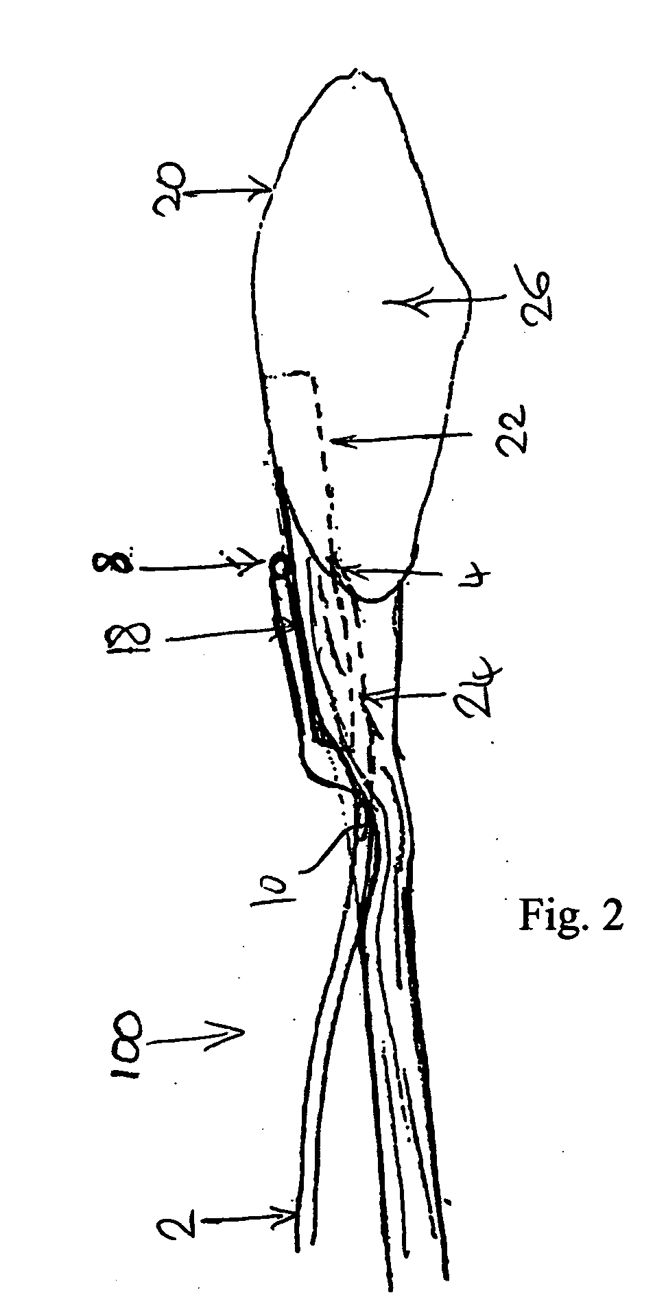 Bone harvesting device and method