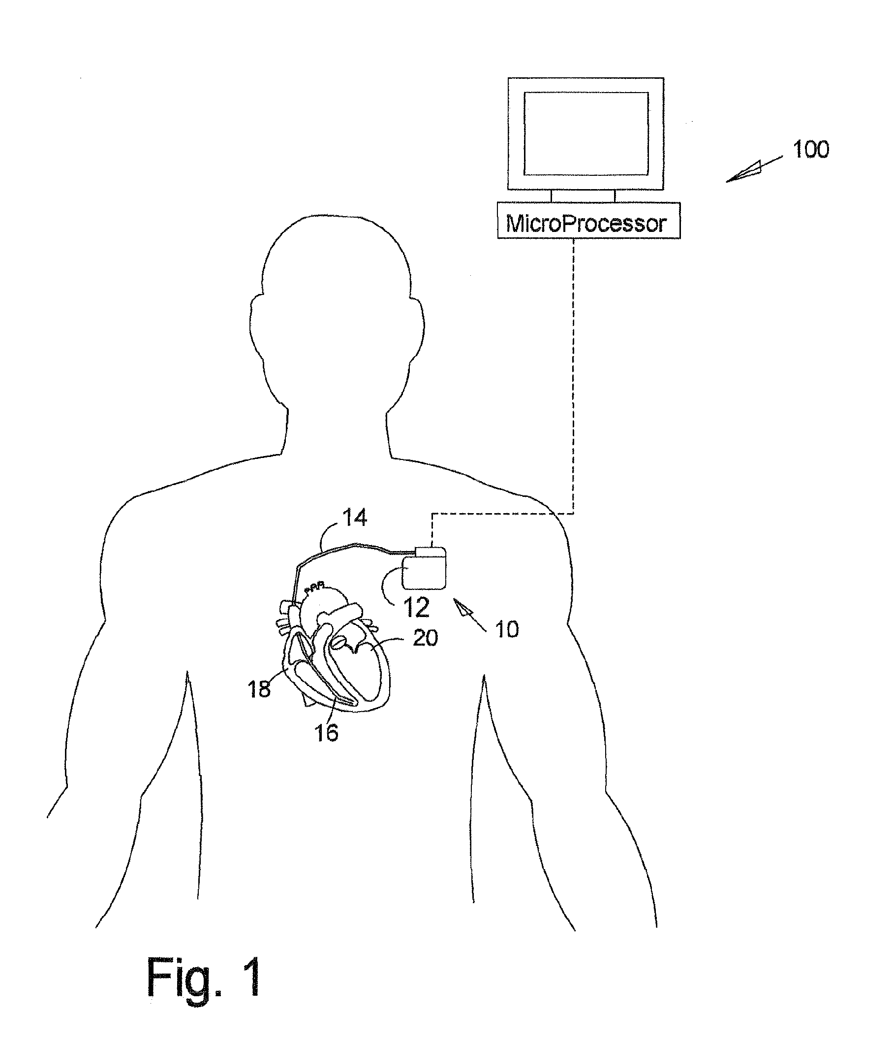 Cardiac pacemaker with loss of atrial capture mode switching and method