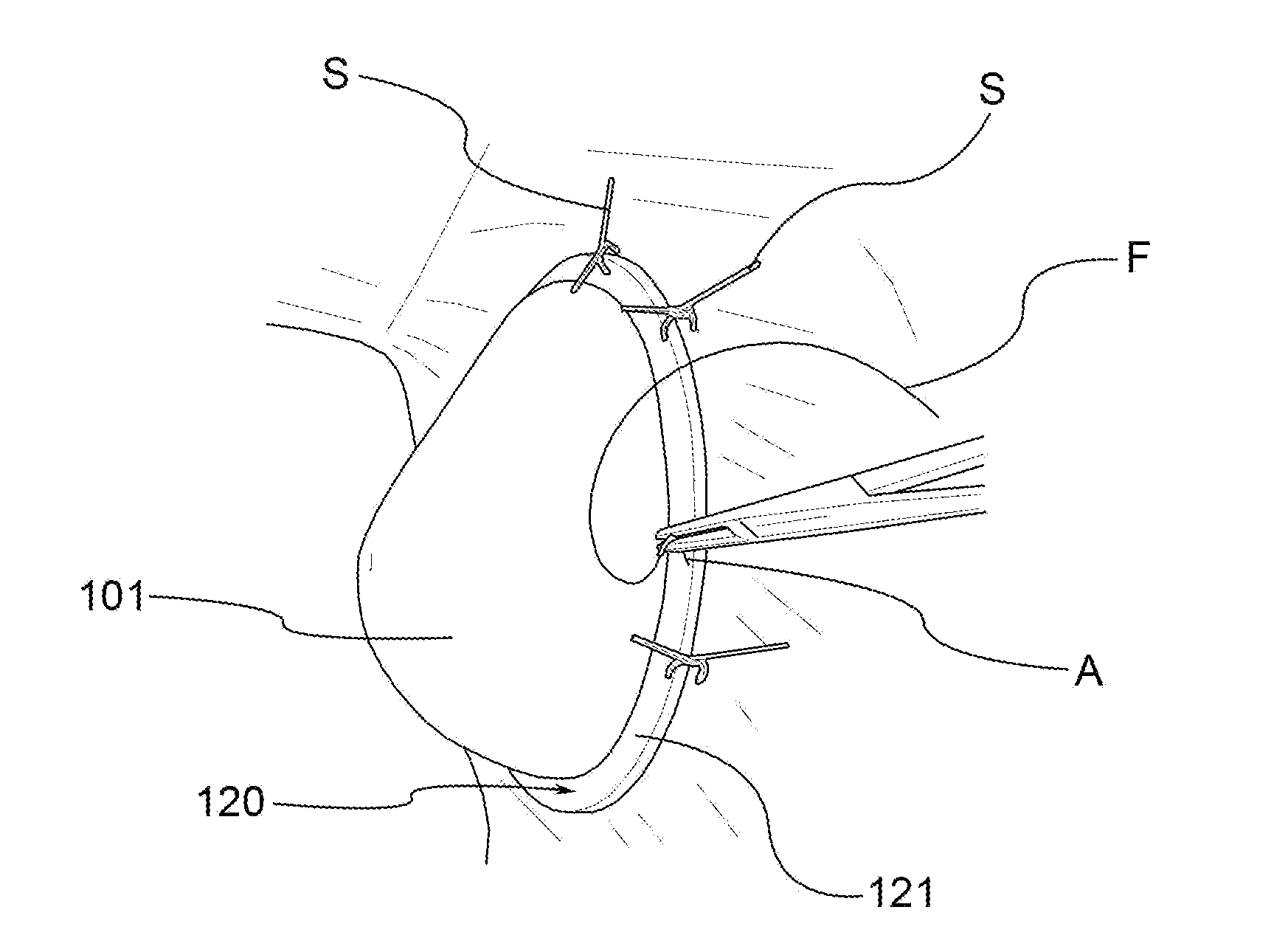 Self-supporting prosthesis for plastic and reconstructive surgery