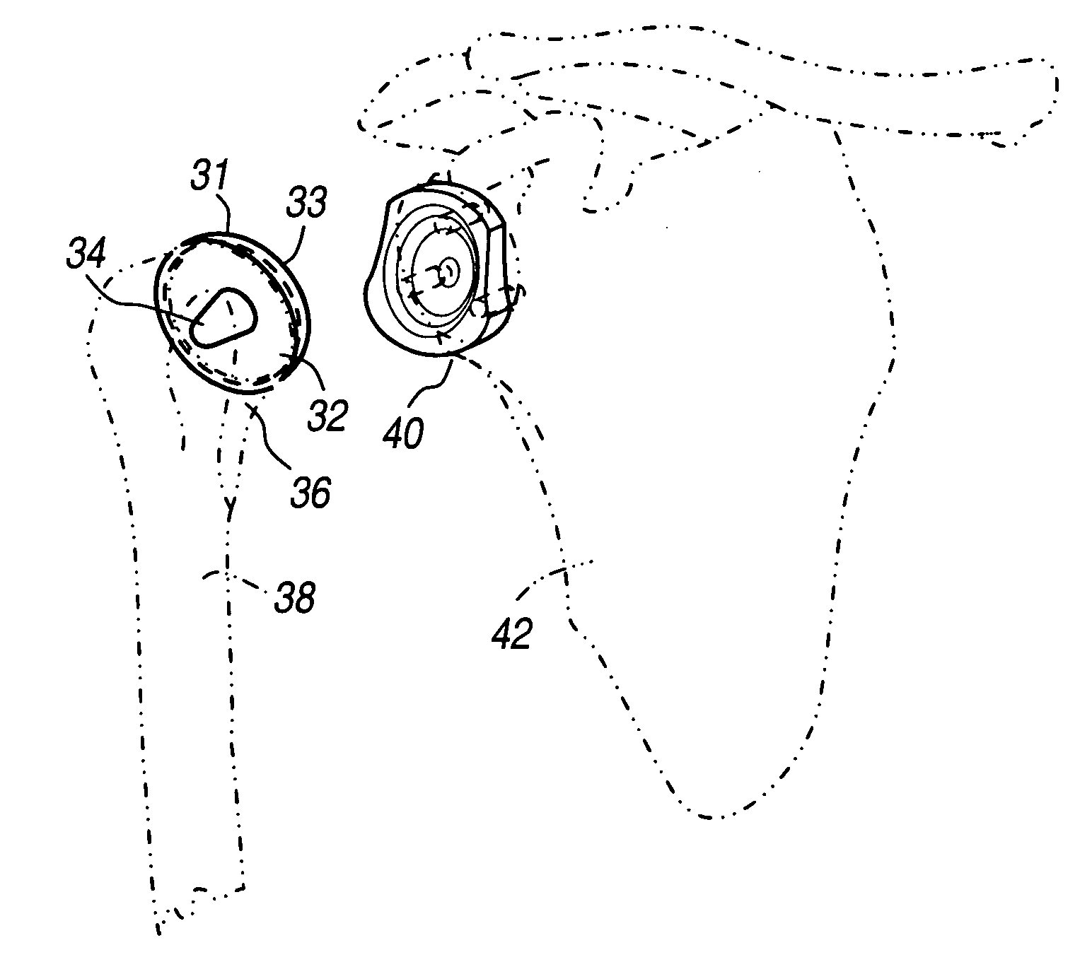 Modular humeral head resurfacing system