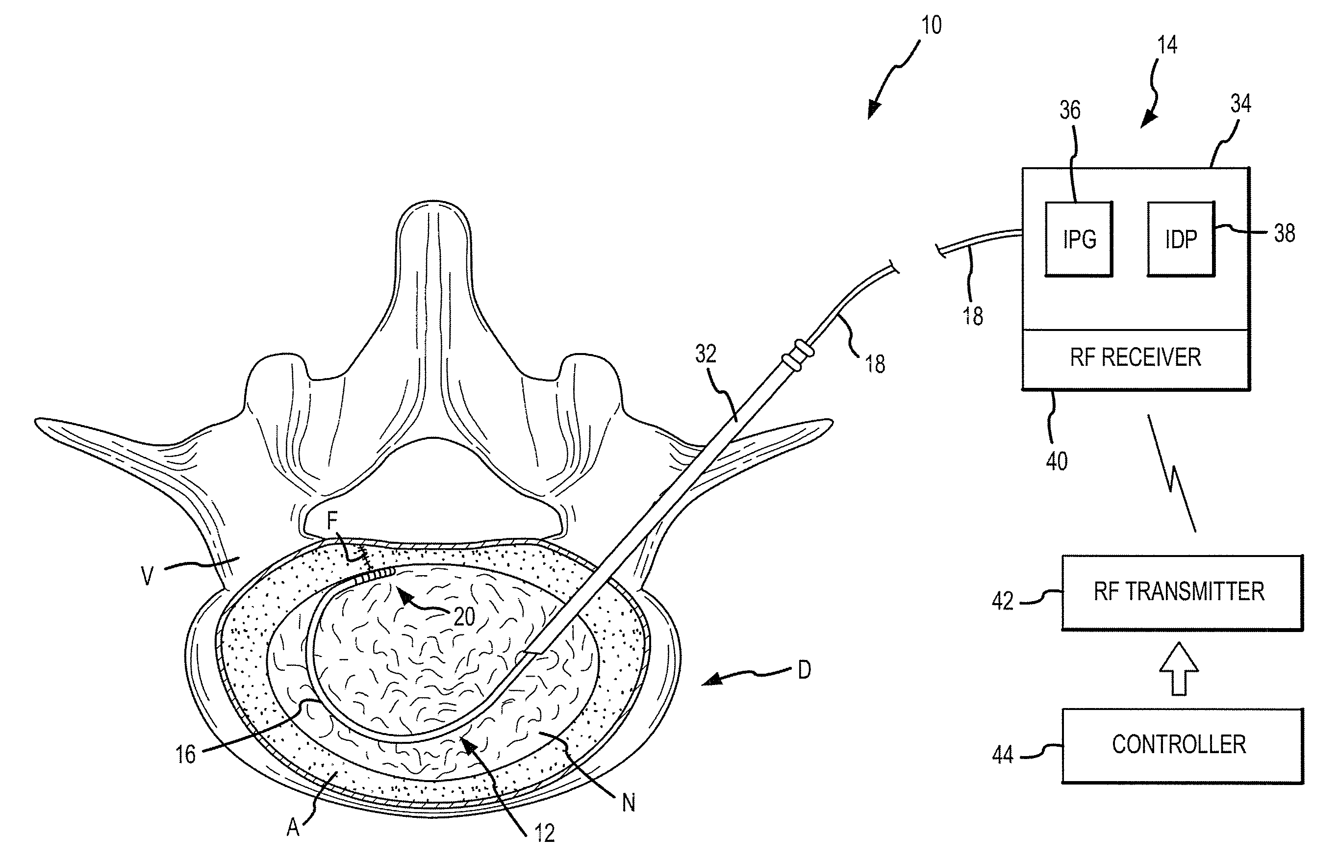 Combination Electrical Stimulating And Infusion Medical Device and Method