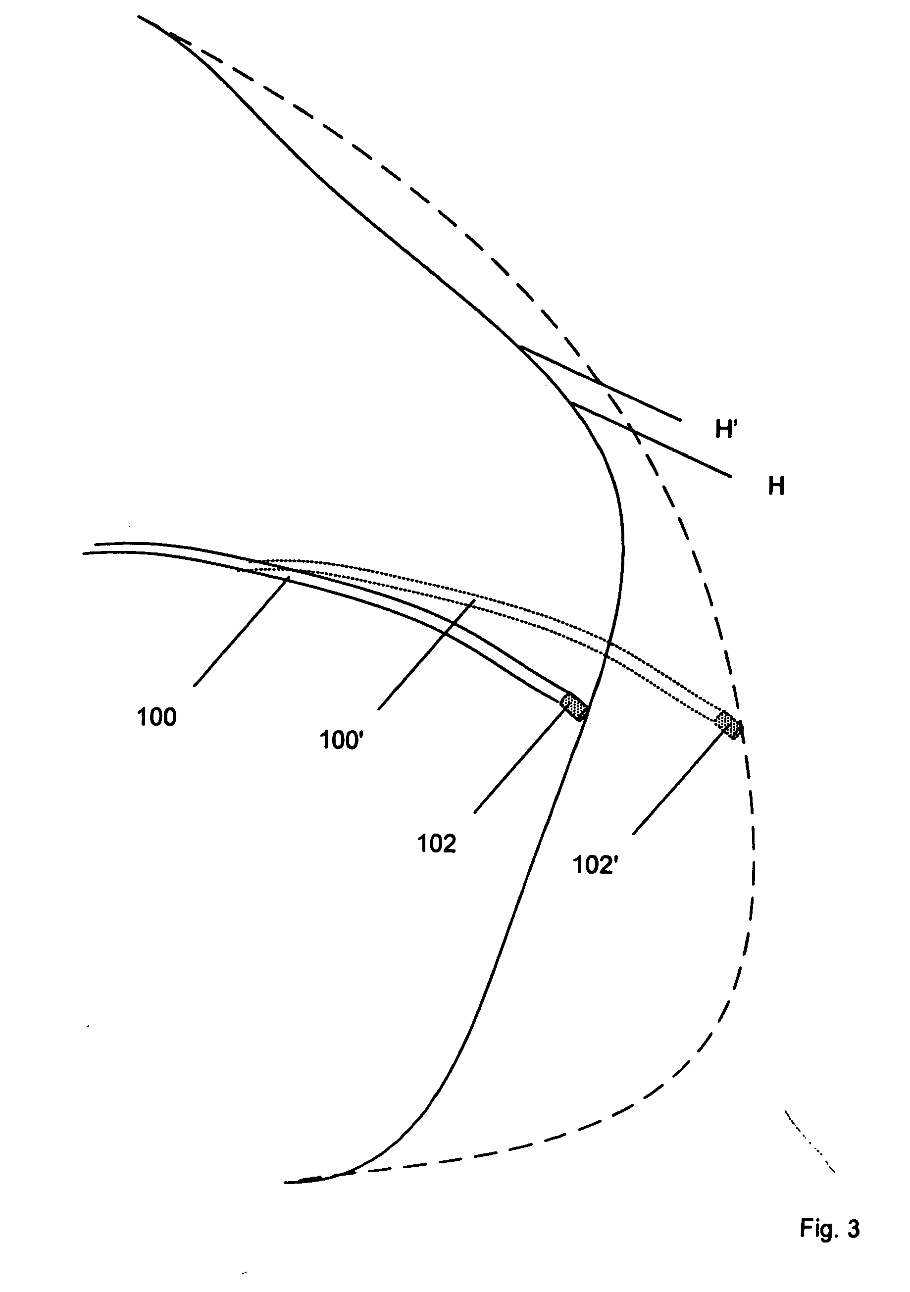 Electrophysiology catheter and system for gentle and firm wall contact