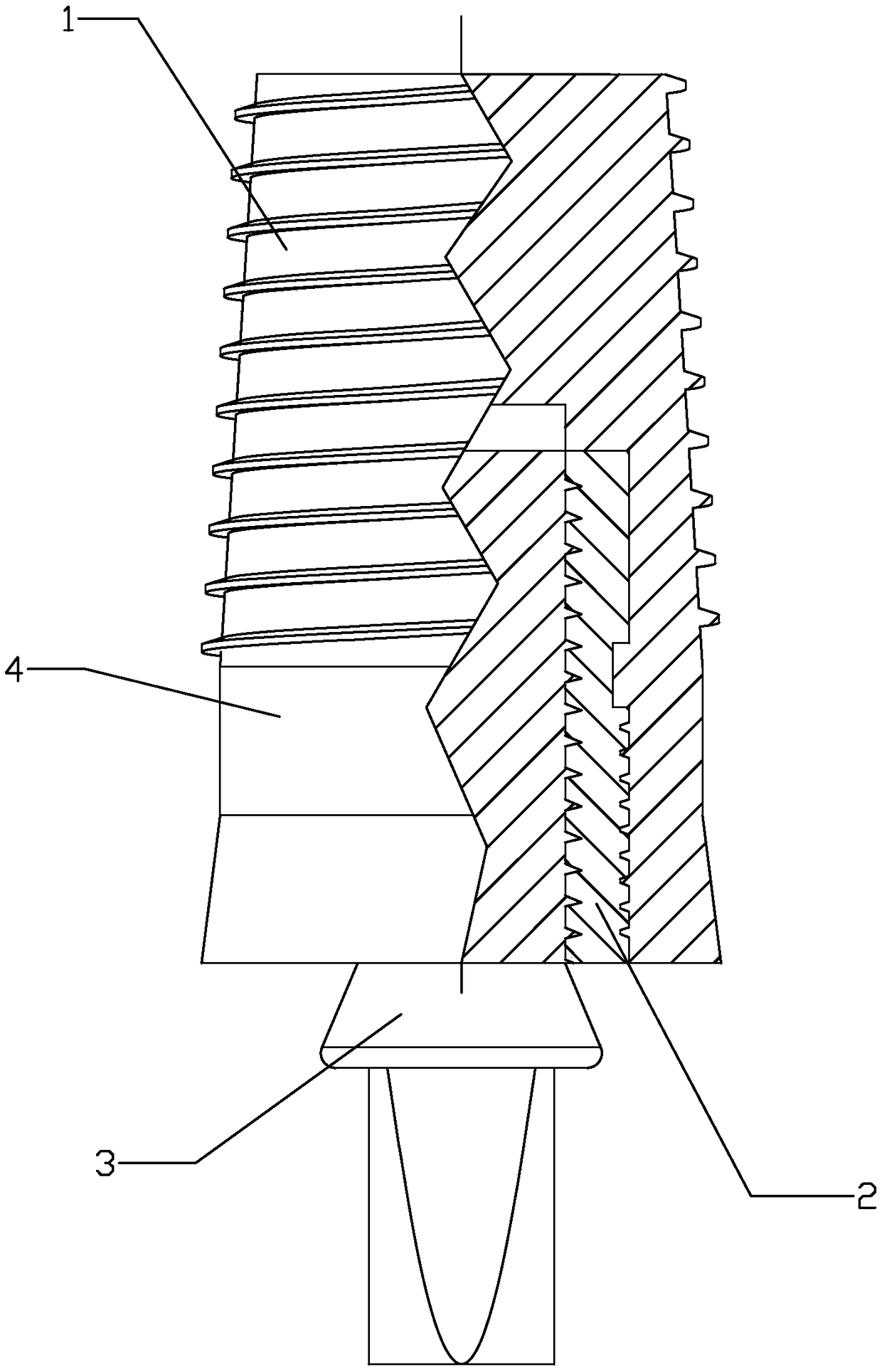 Four-section dental implant