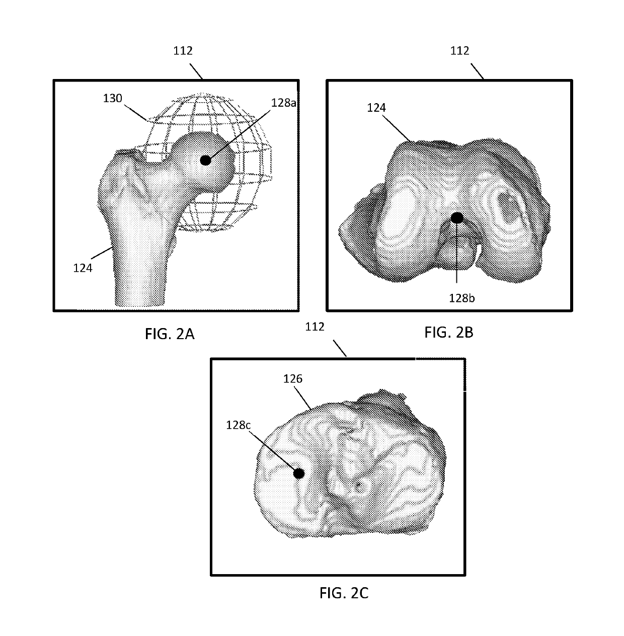 Automated arthroplasty planning