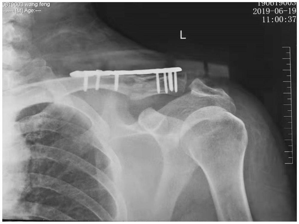 Traditional Chinese medicine composition for treating fracture and traditional Chinese medicine preparation for treating fracture