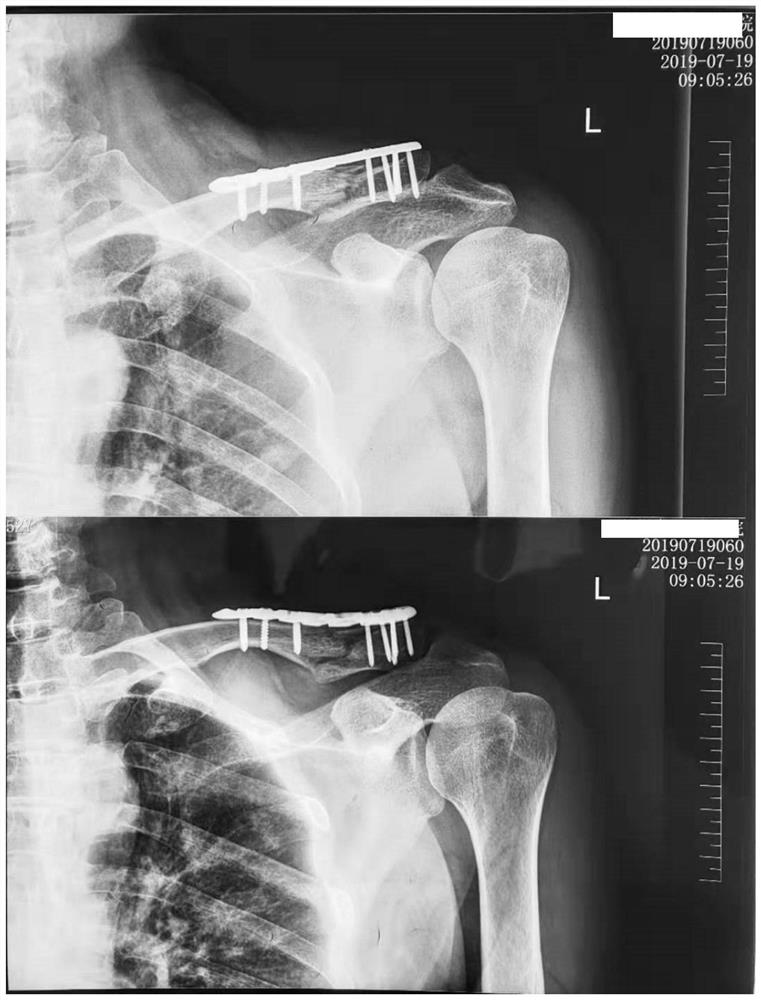 Traditional Chinese medicine composition for treating fracture and traditional Chinese medicine preparation for treating fracture