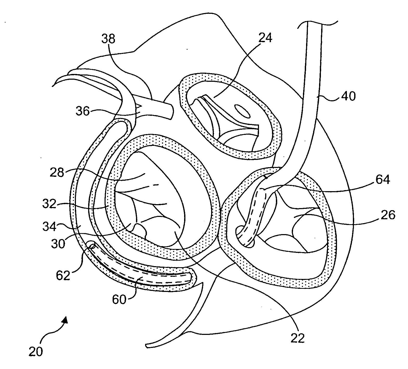 Mitral valve device using conditioned shape memory alloy