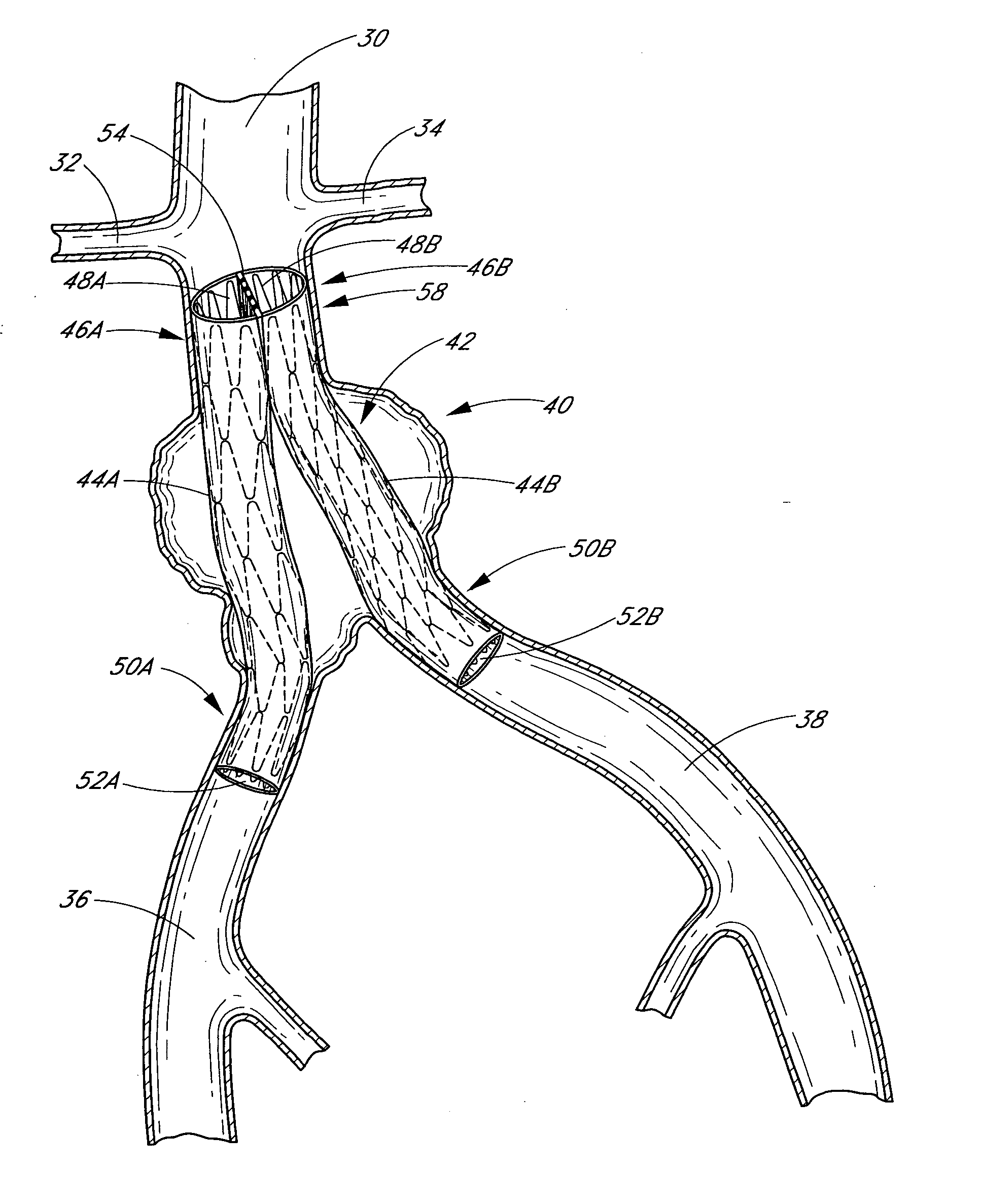 Vascular graft and deployment system