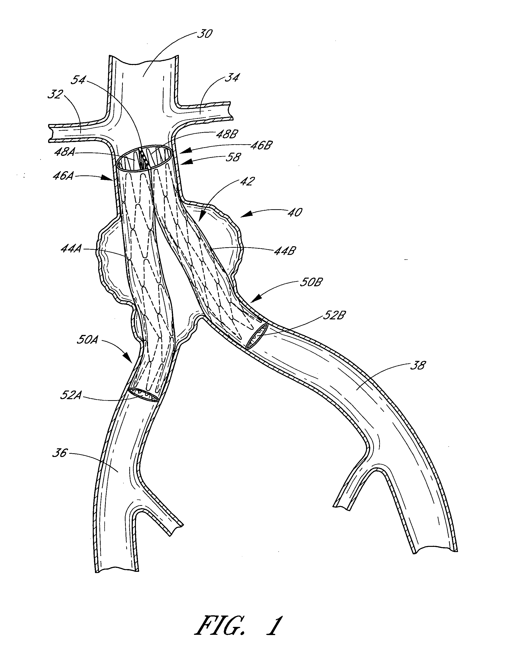 Vascular graft and deployment system