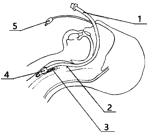 Tracheal catheter capable of rebuilding cough peak flow velocity