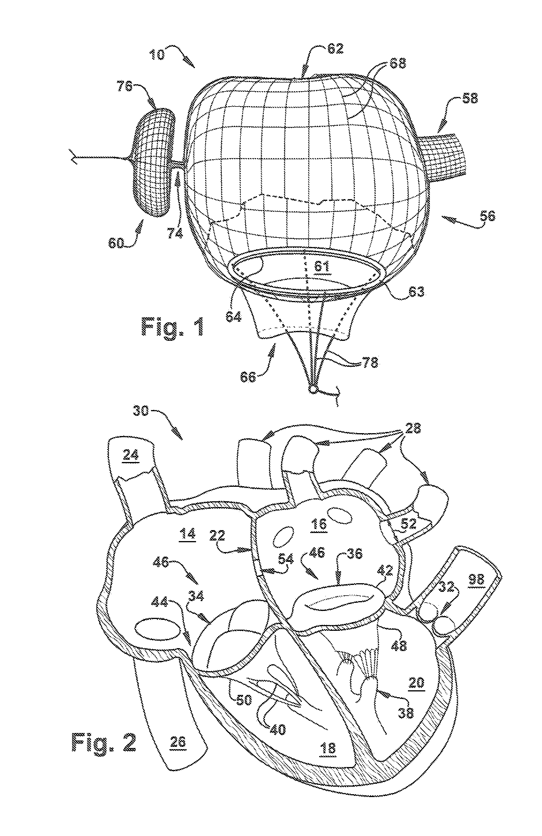 Percutaneous atrioventricular valve and method of use