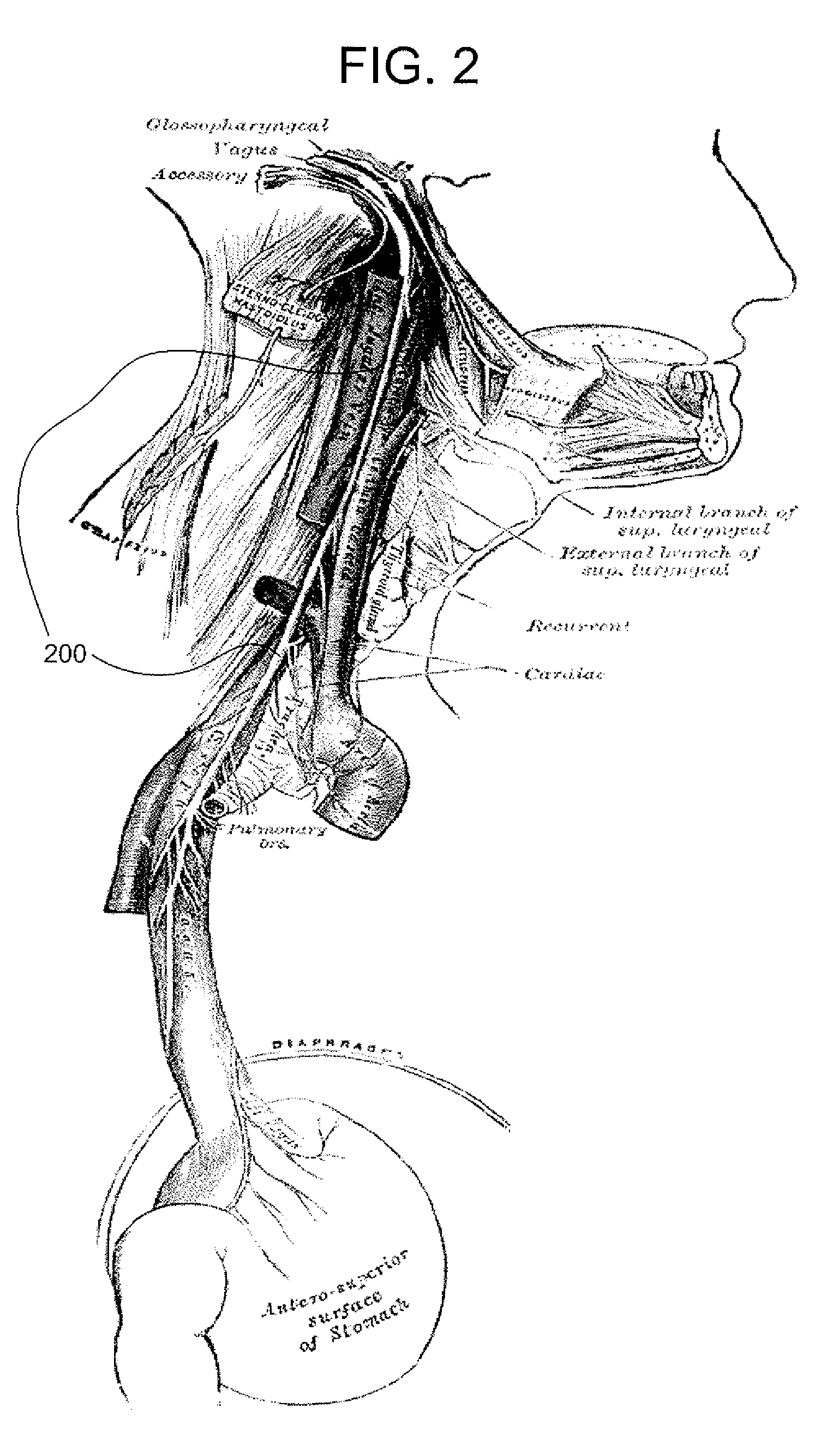 Electrical stimulation treatment of hypotension