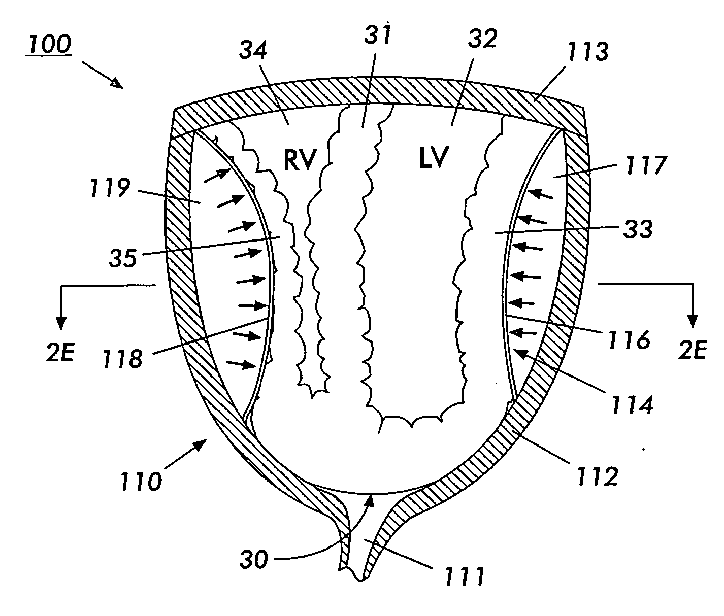 Sensor-equipped and algorithm controlled direct mechanical ventricular assist device