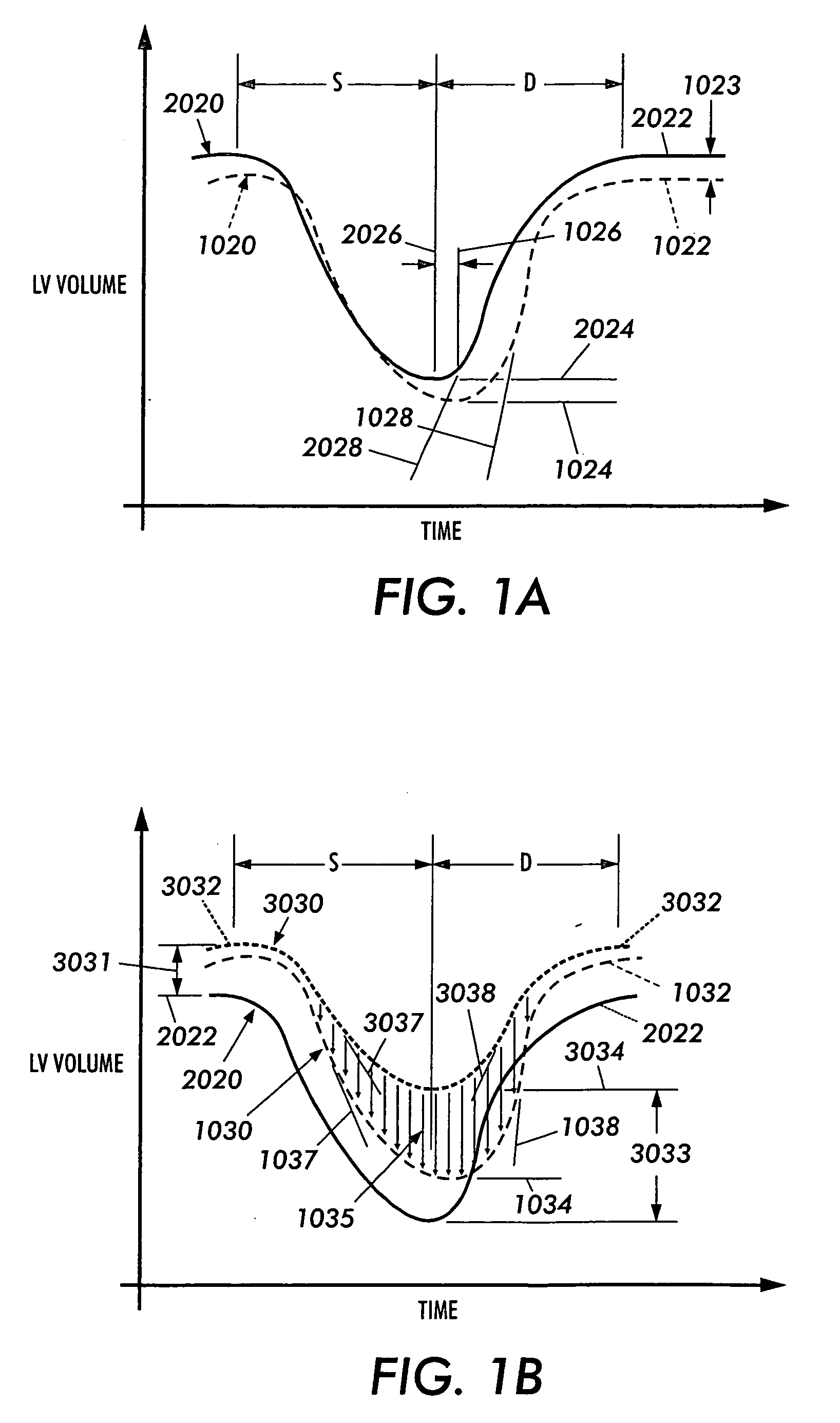 Sensor-equipped and algorithm controlled direct mechanical ventricular assist device