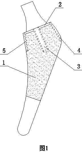 Locking type artificial femoral stem